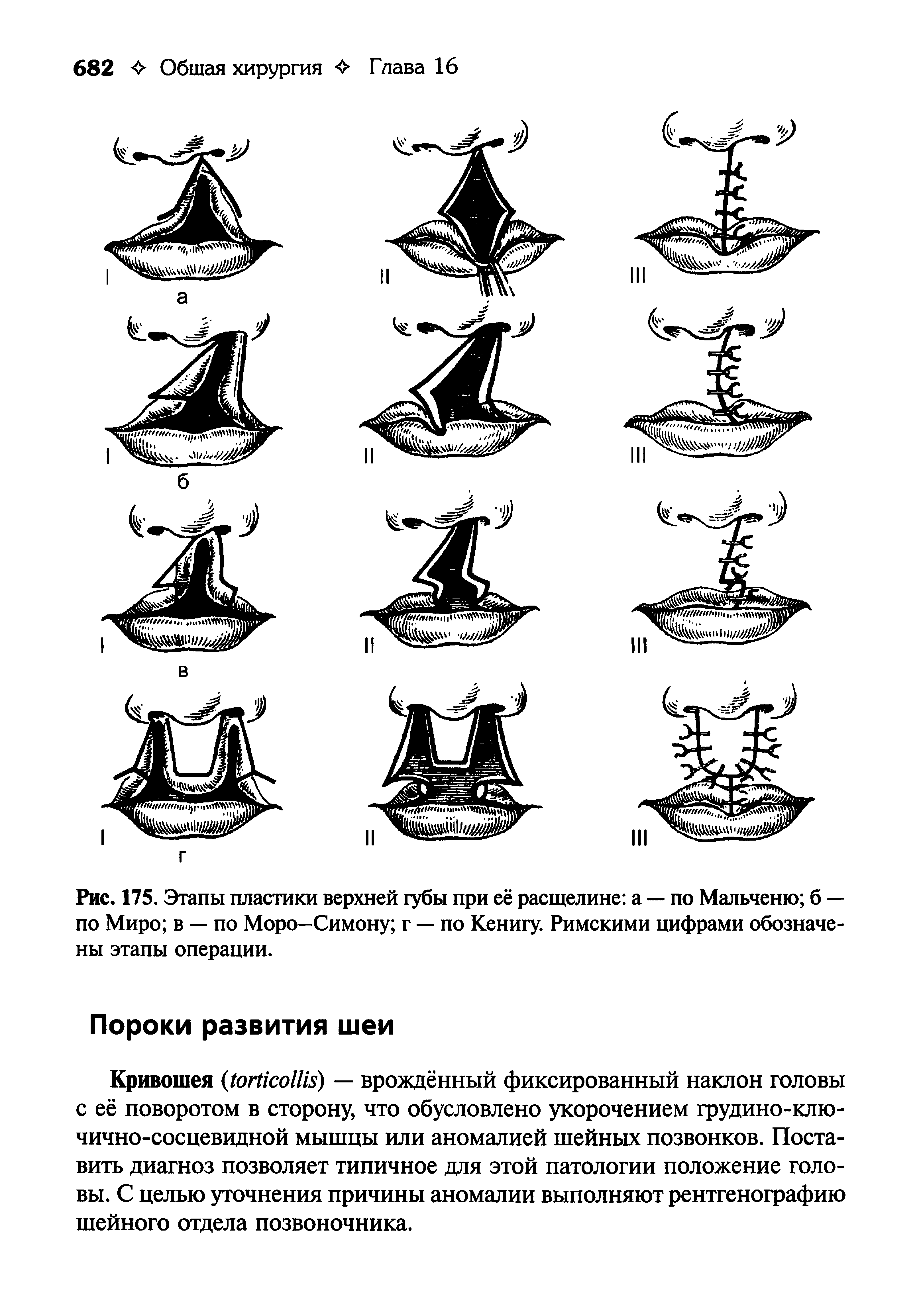 Рис. 175. Этапы пластики верхней губы при её расщелине а — по Мальченю б — по Миро в — по Моро—Симону г — по Кенигу. Римскими цифрами обозначены этапы операции.