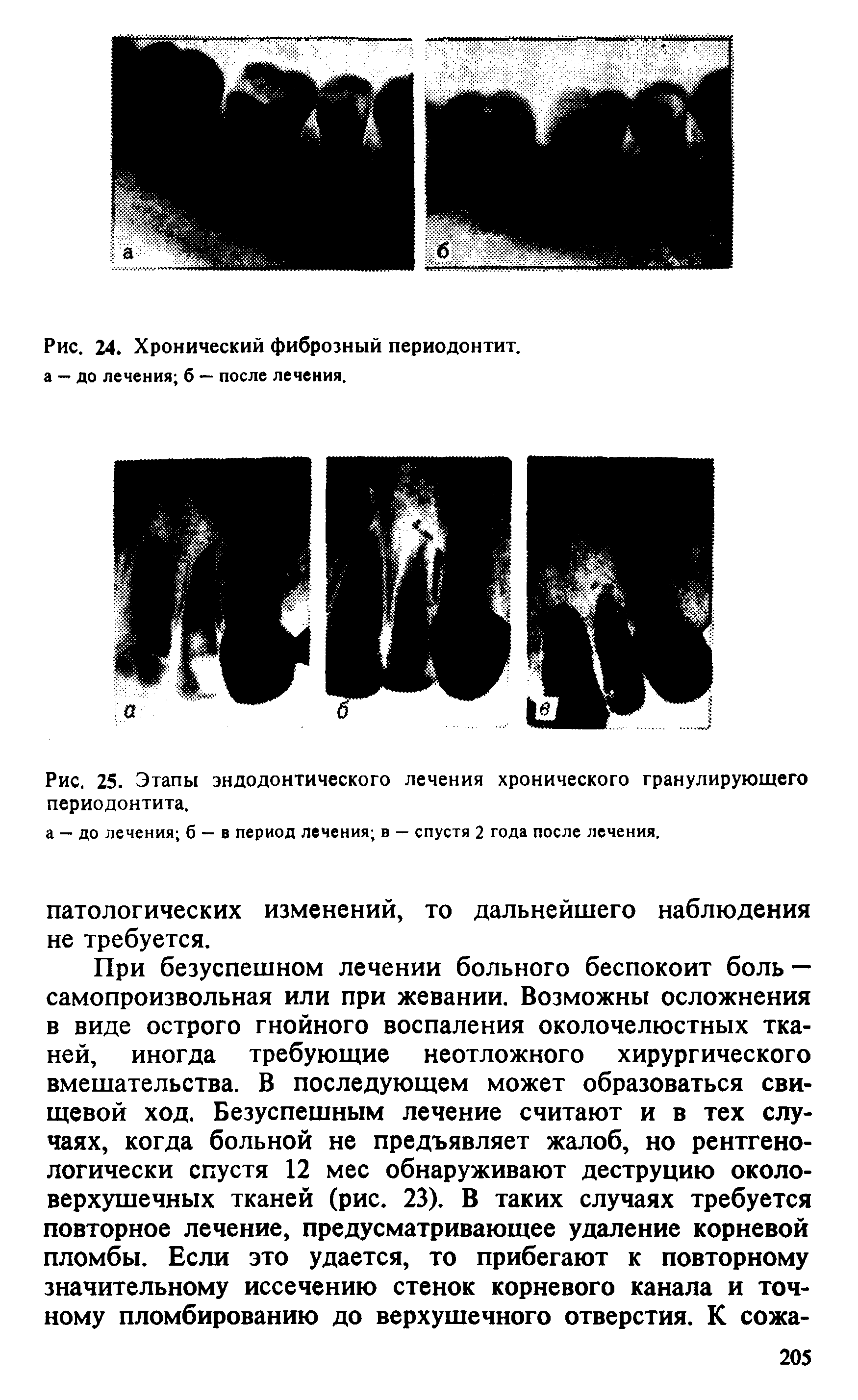 Рис. 25. Этапы эндодонтического лечения хронического гранулирующего периодонтита.