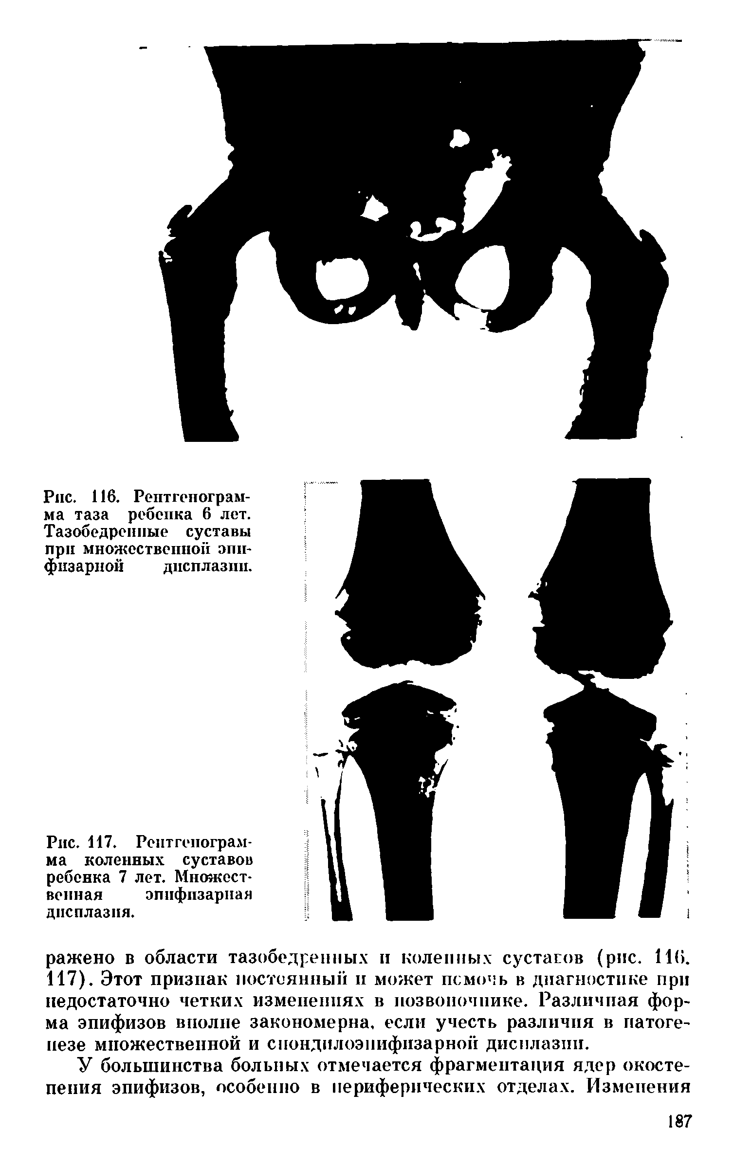 Рис. 117. Рентгенограмма коленных суставов ребенка 7 лет. Множественная эпифизарная дисплазия.