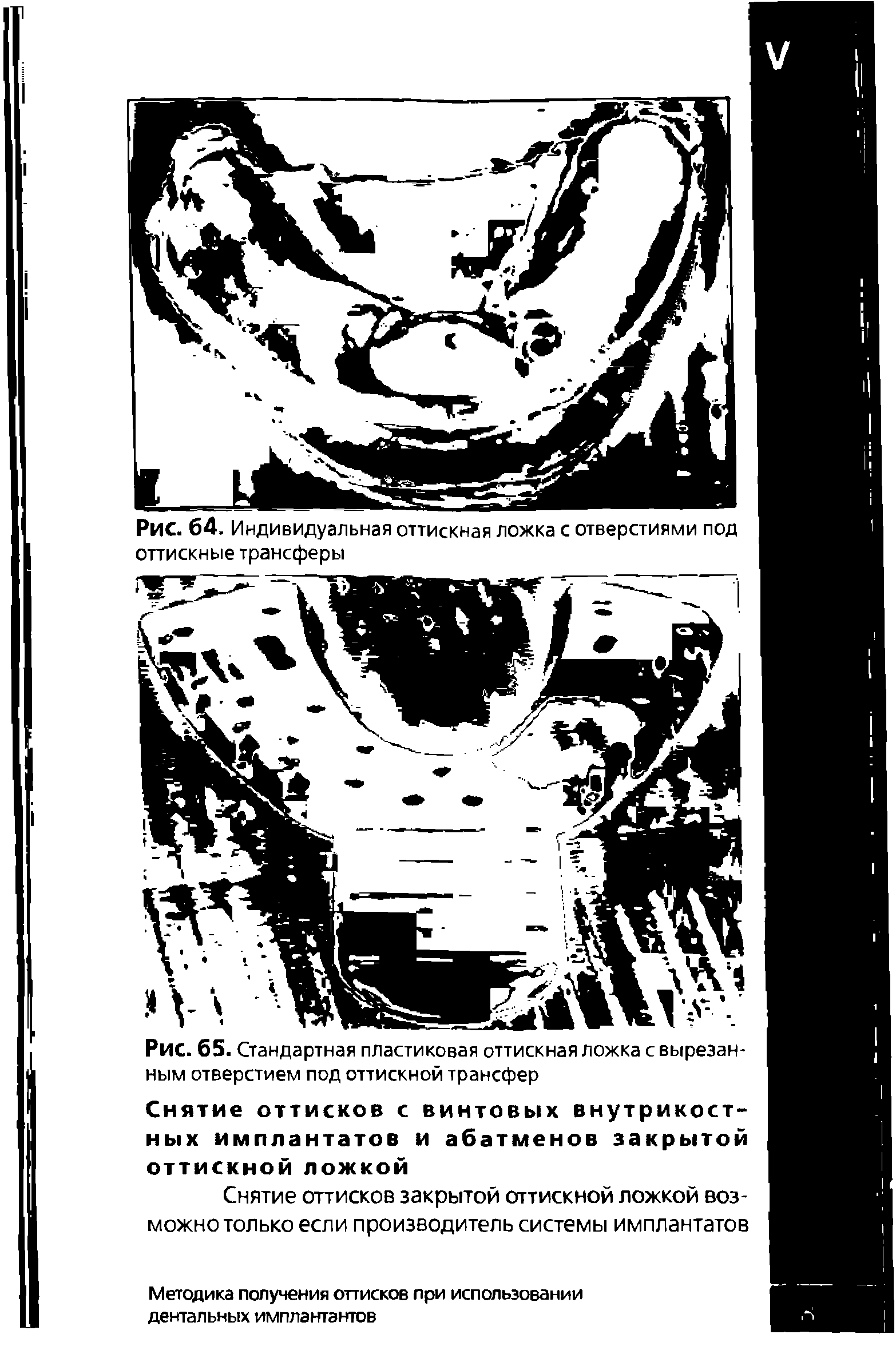 Рис. 65. Стандартная пластиковая оттискная ложка с вырезанным отверстием под оттискной трансфер...