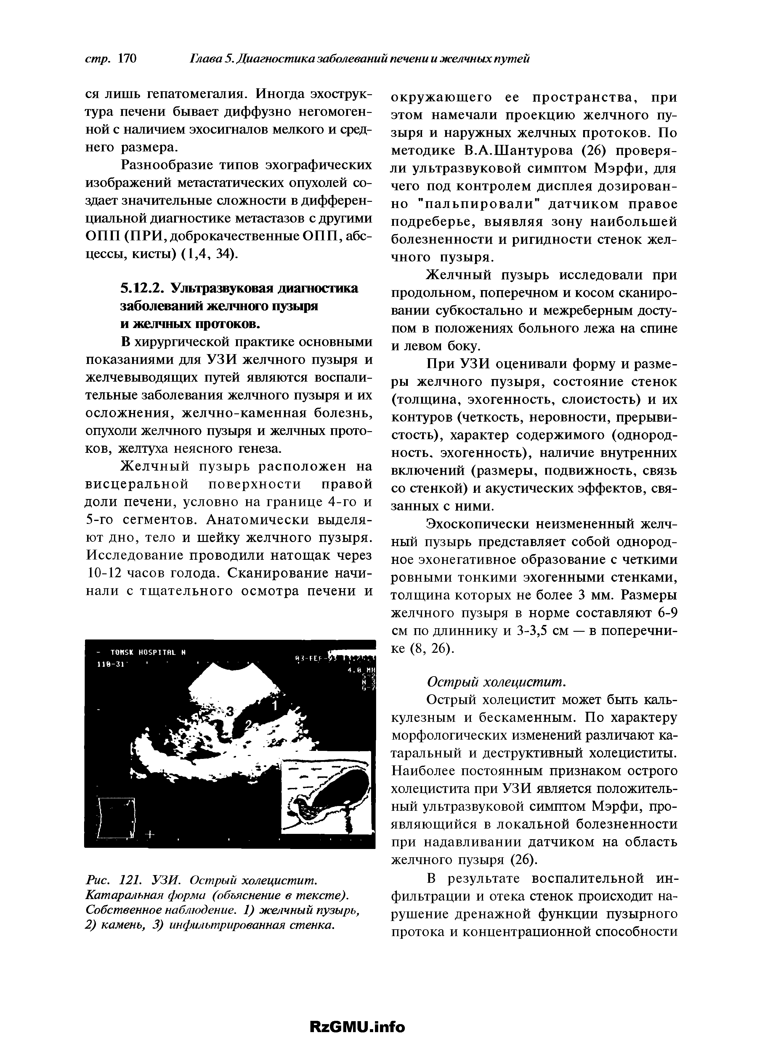 Рис. 121. УЗИ. Острый холецистит. Катаральная форма (объяснение в тексте). Собственное наблюдение. 1) желчный пузырь, 2) камень, 3) инфильтрированная стенка.