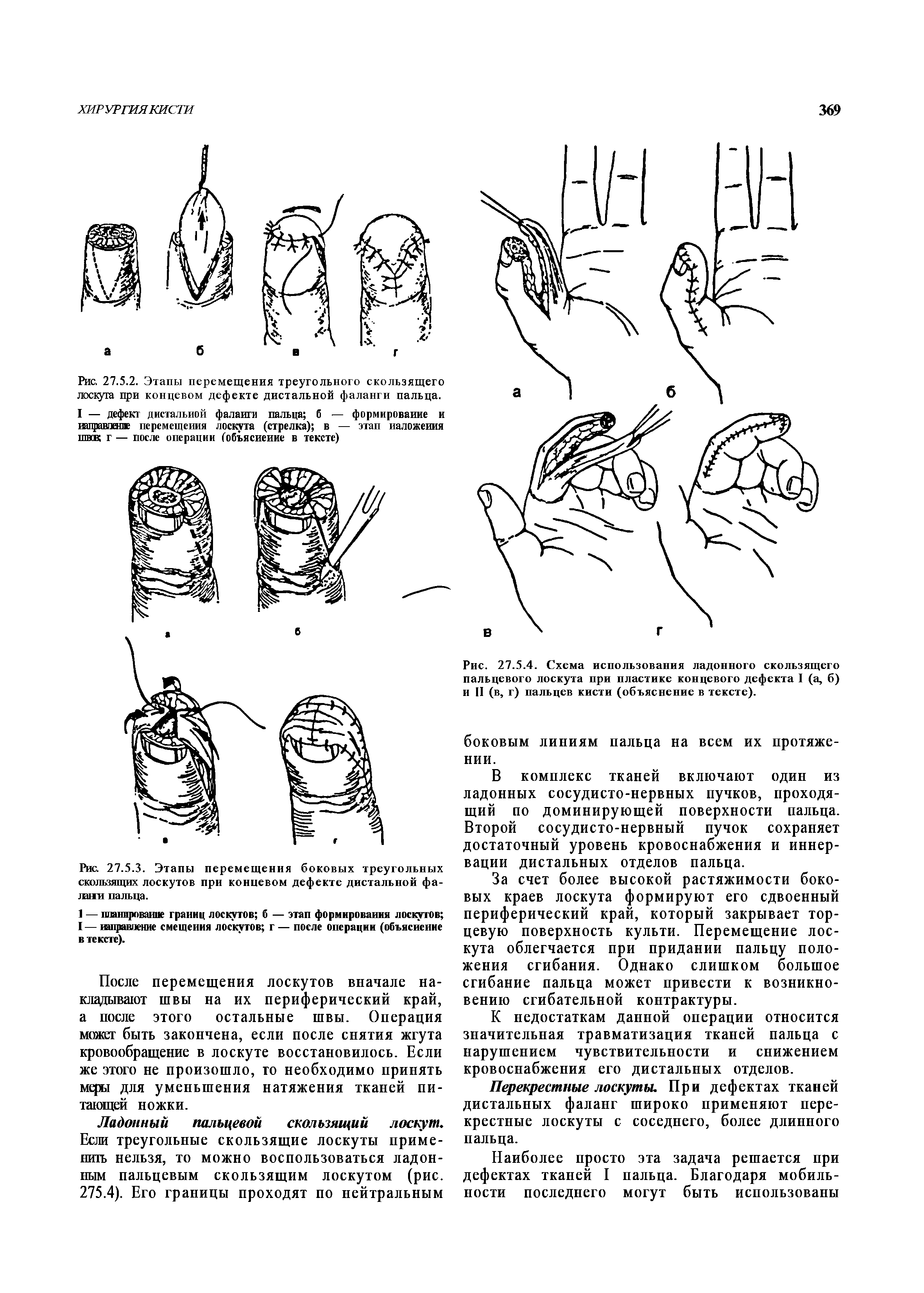 Рис. 27.5.3. Этапы перемещения боковых треугольных скользящих лоскутов при концевом дефекте дистальной фалини пальца.