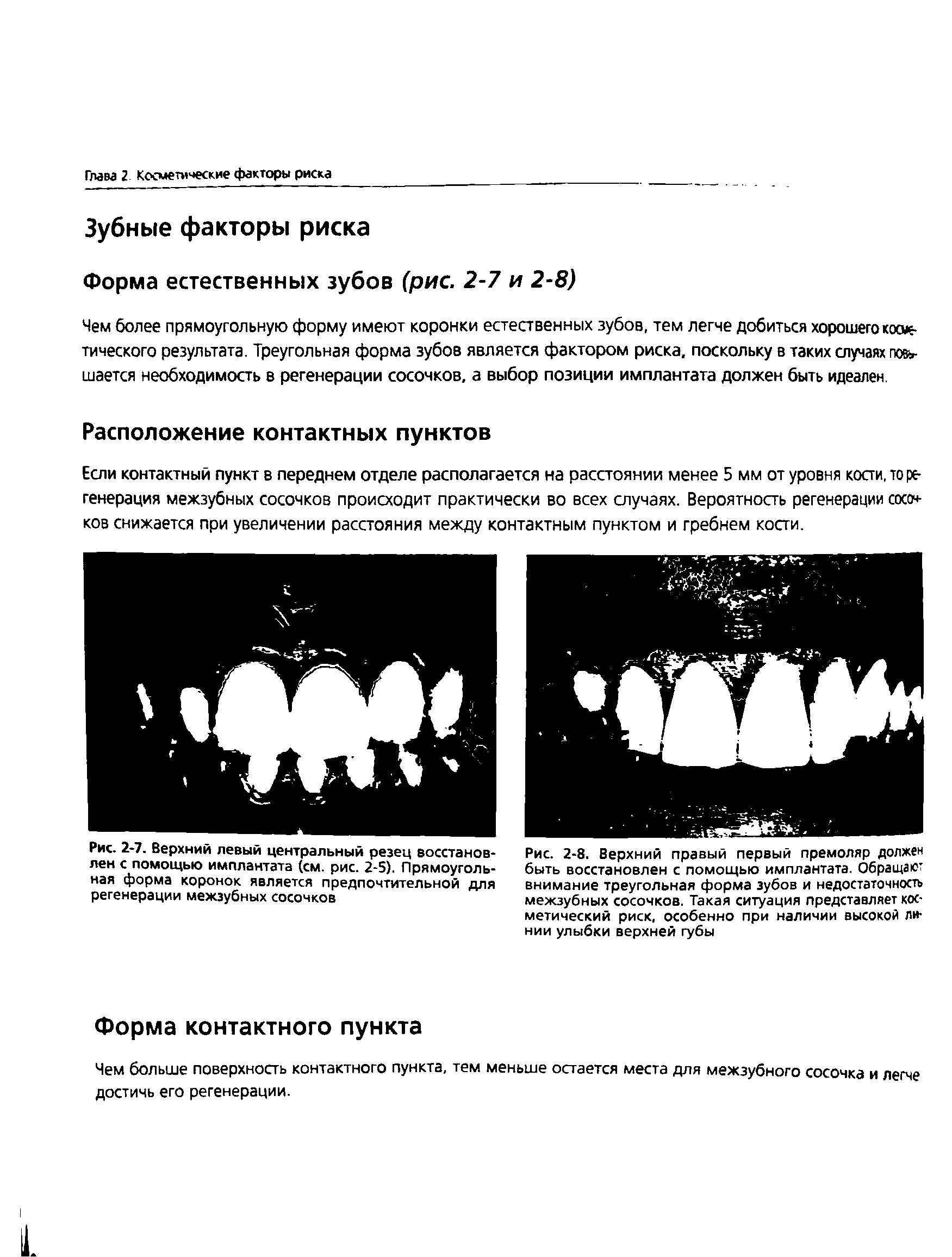 Рис. 2-8. Верхний правый первый премоляр должен быть восстановлен с помощью имплантата. Обращает внимание треугольная форма зубов и недостаточность межзубных сосочков. Такая ситуация представляет косметический риск, особенно при наличии высокой линии улыбки верхней губы...