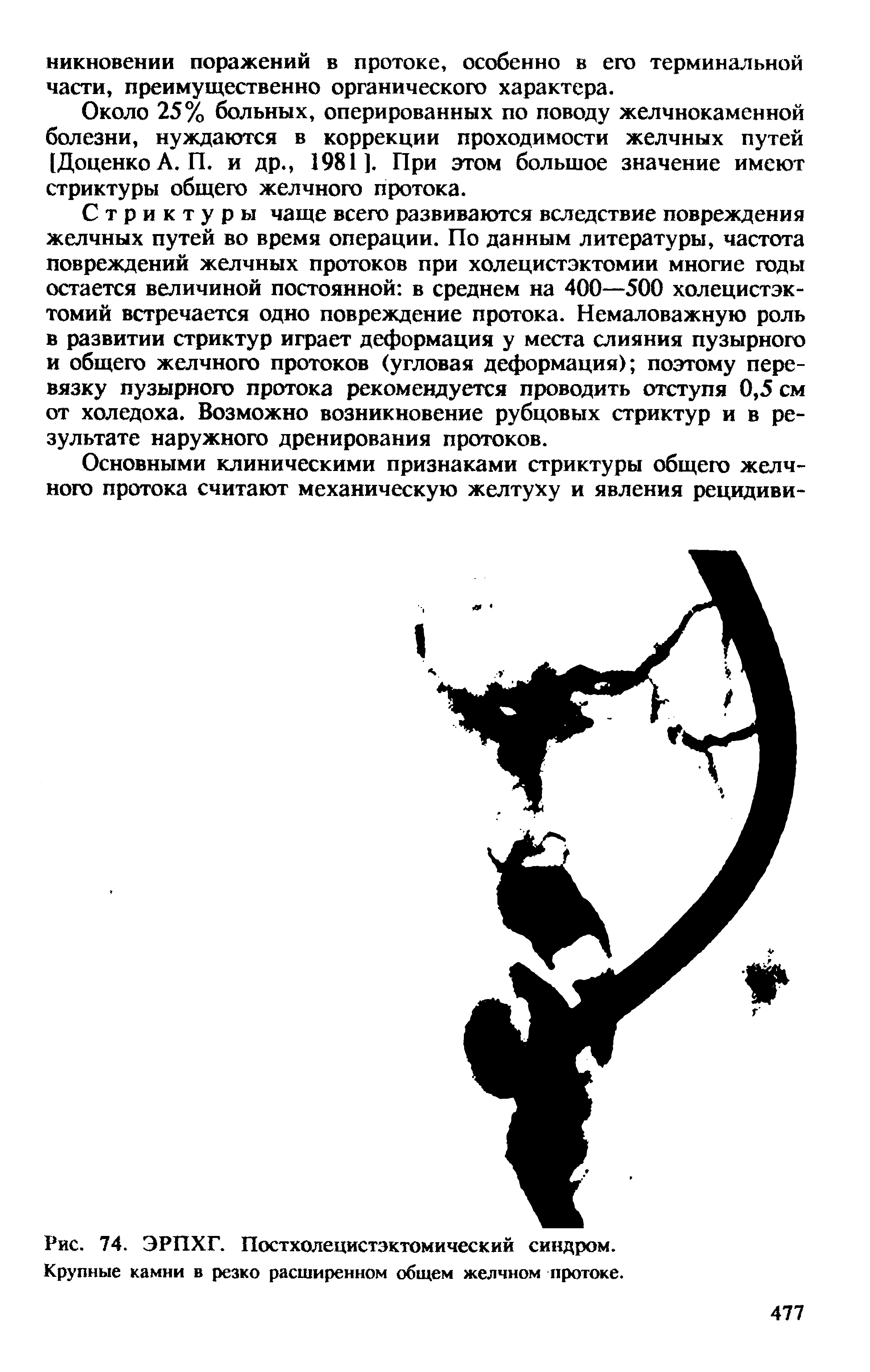 Рис. 74. ЭРПХГ. Постхолецистэктомический синдром. Крупные камни в резко расширенном общем желчном протоке.