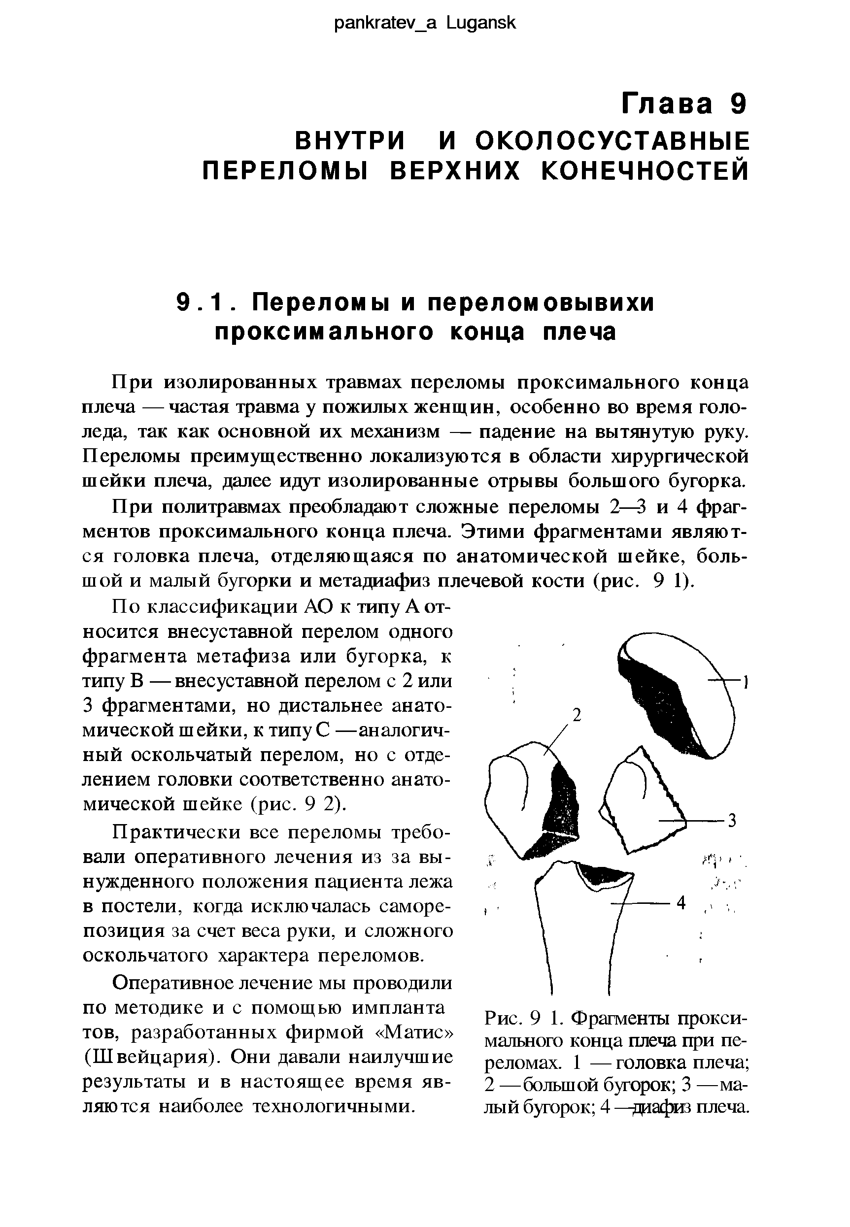 Рис. 9 1. Фрагменты проксимального конца плеча при переломах. 1 — головка плеча 2 —большой бугорок 3 —малый бугорок 4 —даафиз плеча.