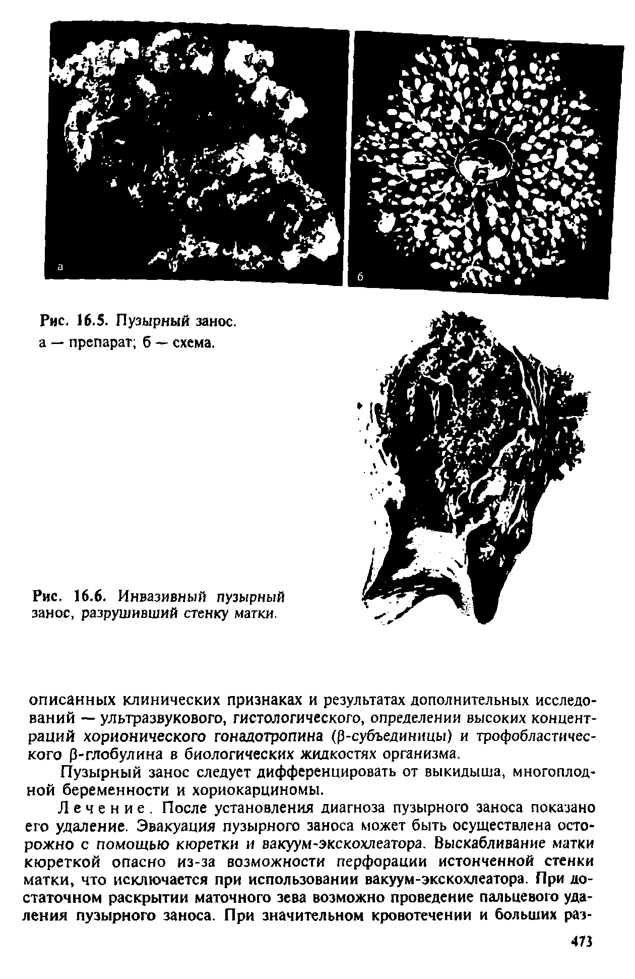 Рис. 16.6. Инвазивный пузырный занос, разрушивший стенку матки.