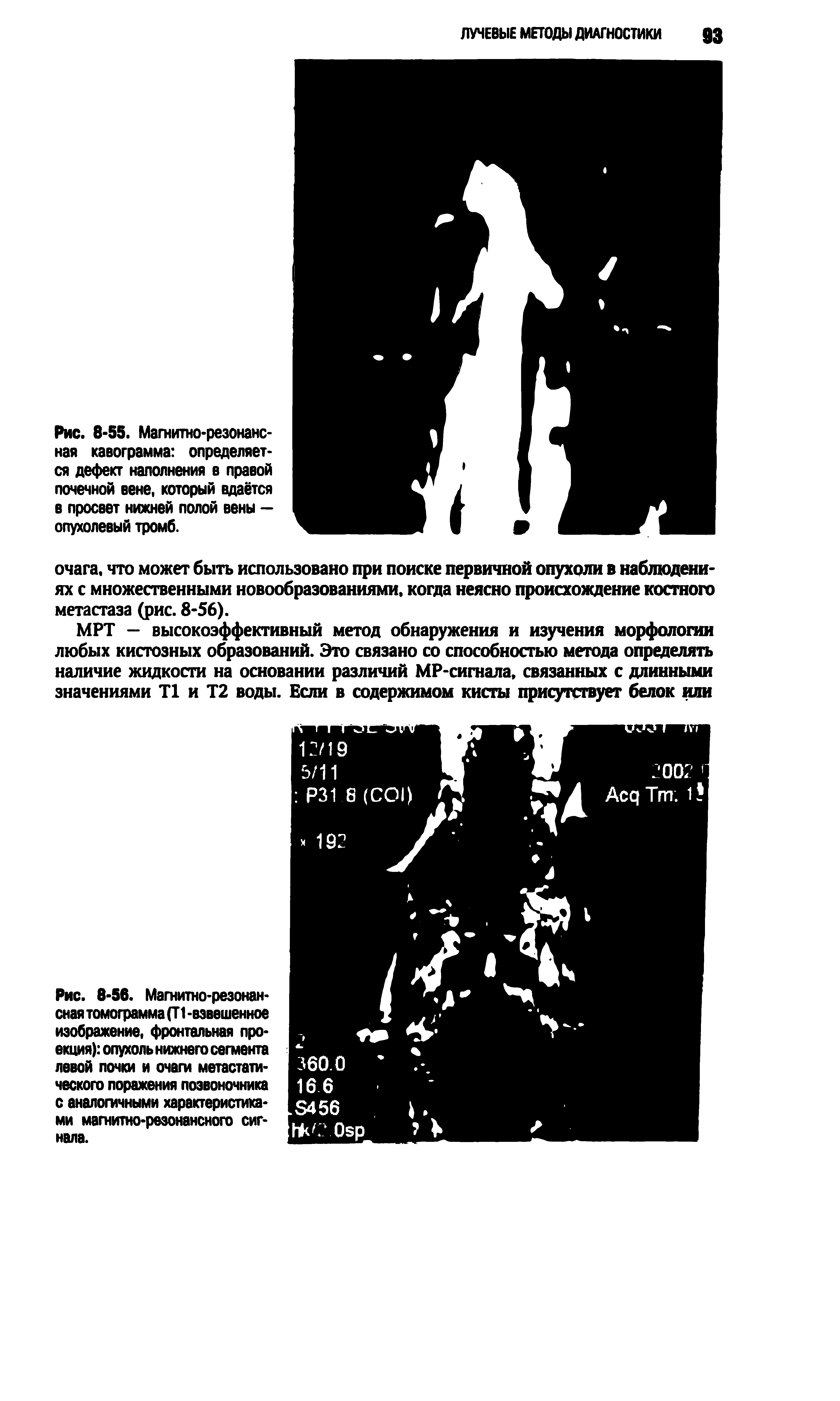 Рис. 8-56. Магнитно-резонансная томограмма (Г 1 -взвешенное изображение, фронтальная проекция) опухоль нижнего сегмента левой почки и очаги метастатического поражения позвоночника с аналогичными характеристиками магнитно-резонансного сигнала.