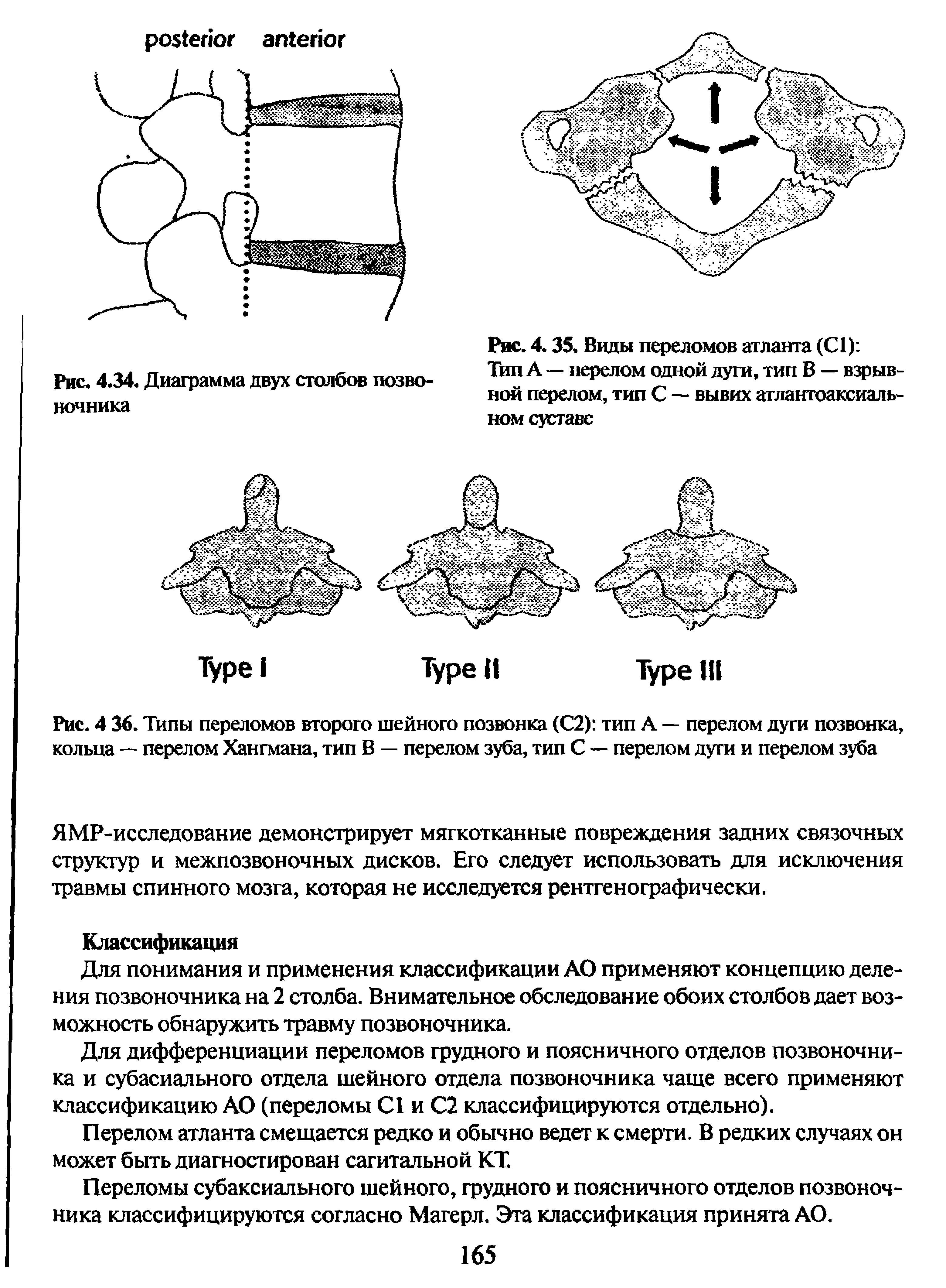 Рис. 4 36. Типы переломов второго шейного позвонка (С2) тип А — перелом дуги позвонка, кольца — перелом Хангмана, тип В — перелом зуба, тип С — перелом дуги и перелом зуба...