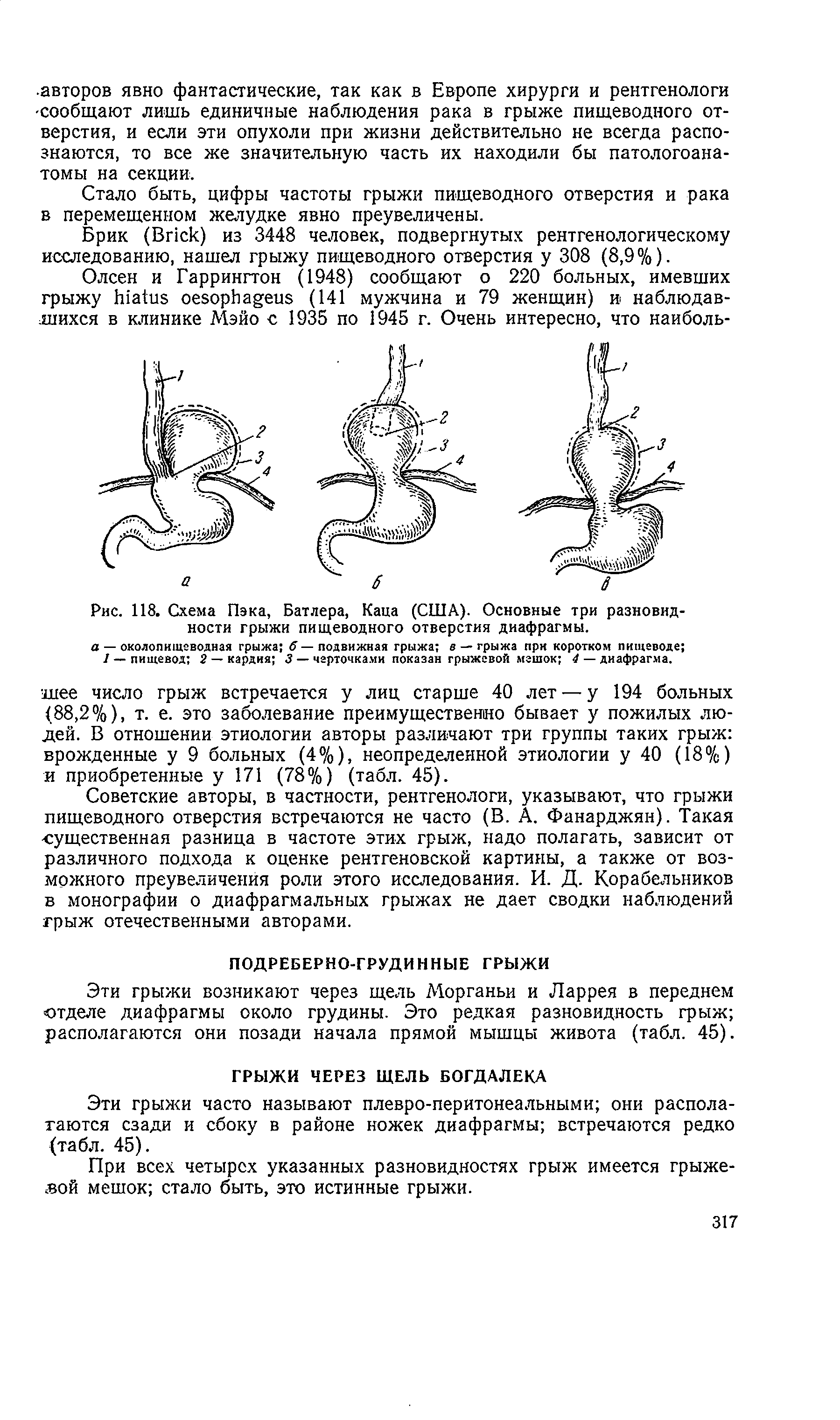 Рис. 118. Схема Пэка, Батлера, Каца (США). Основные три разновидности грыжи пищеводного отверстия диафрагмы.