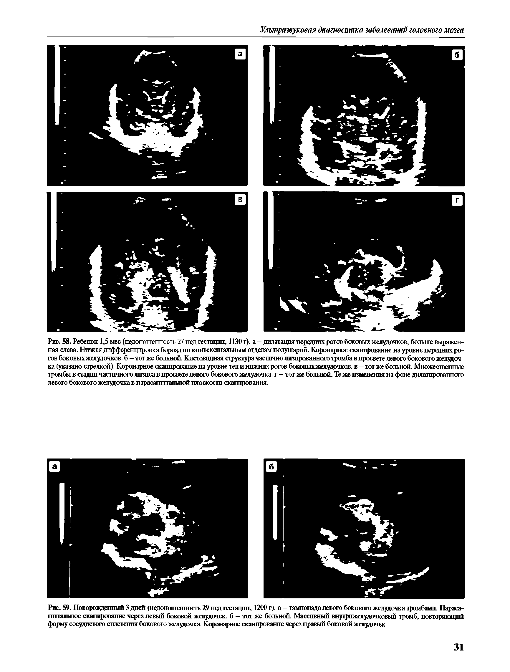 Рис. 59. Новорожденный 3 дней (недоношенность 09 нед гестации, 1200 г), а - тампонада левого бокового желудочка тромбами. Параса-ппталшое сканирование через левый боковой желудочек. 6 — тот же больной. Массивный внутрижелудочковый тромб, повторяющий форму сосудистого сплетения бокового желудочка. Коронарное сканирование через правый боковой желудочек.