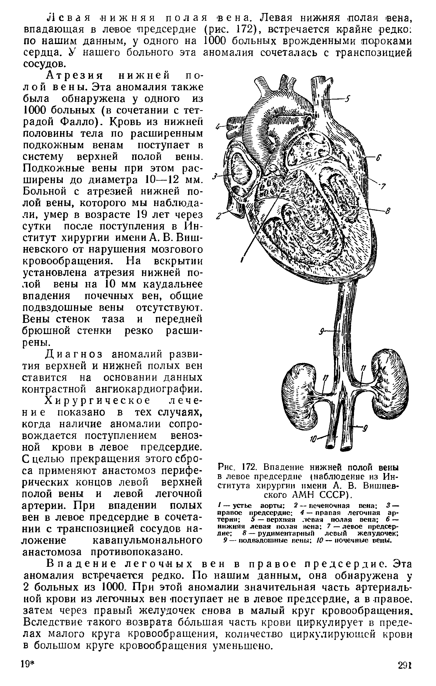 Рис. 172. Впадение нижней полой вены в левое предсердие (наблюдение из Института хирургии имени А. В. Вишневского АМН СССР).