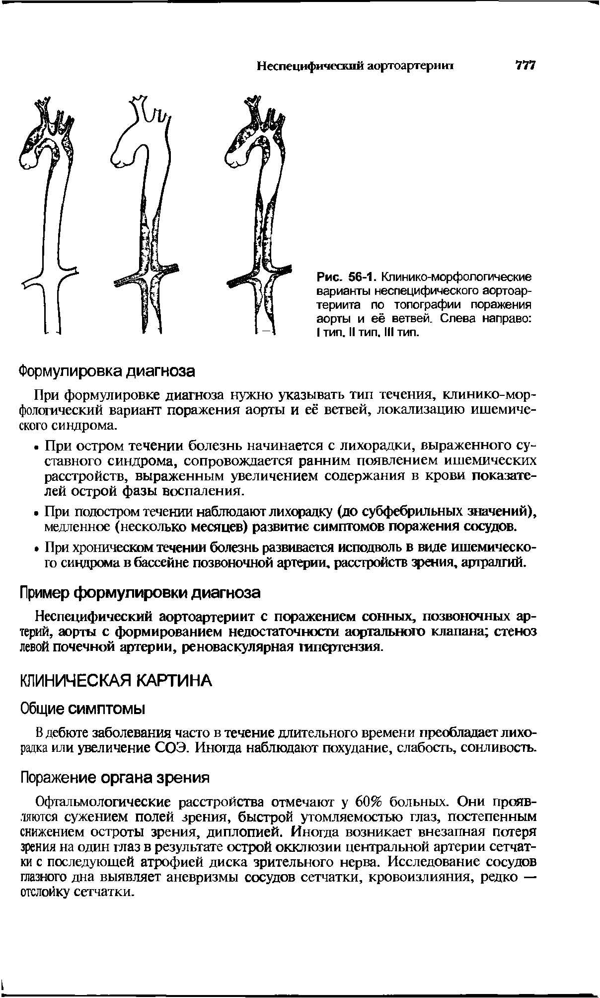 Рис. 56-1. Клинико-морфологические варианты неспецифического аортоар-териита по топографии поражения аорты и её ветвей. Слева направо I тип. II тип. I тип.