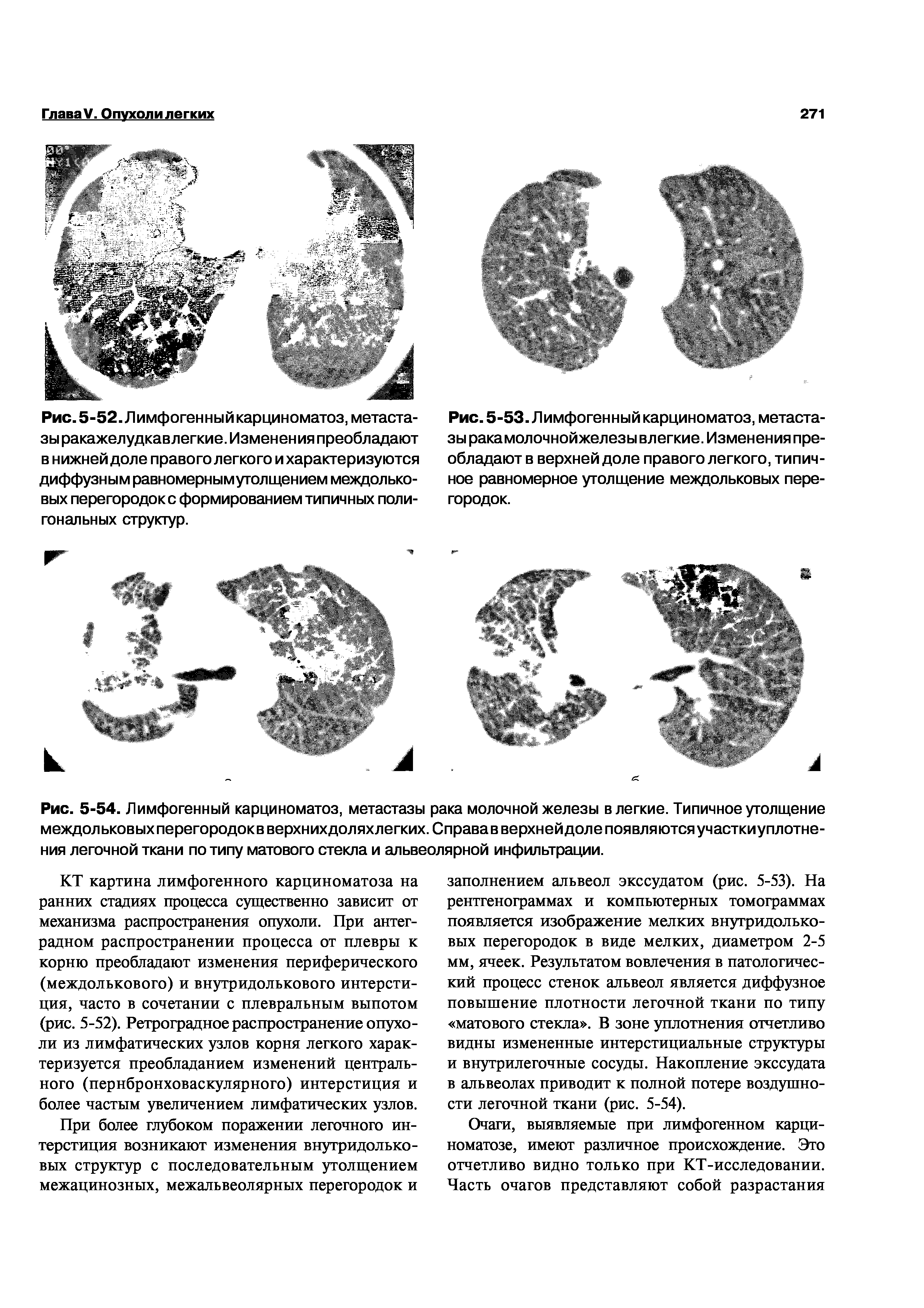 Рис. 5-54. Лимфогенный карциноматоз, метастазы рака молочнойжелезы в легкие. Типичное утолщение междол ьковых перегородокв верхнихдоляхлегких.Справав верхней доле появляются участкиуплотне-ния легочной ткани по типу матового стекла и альвеолярной инфильтрации.