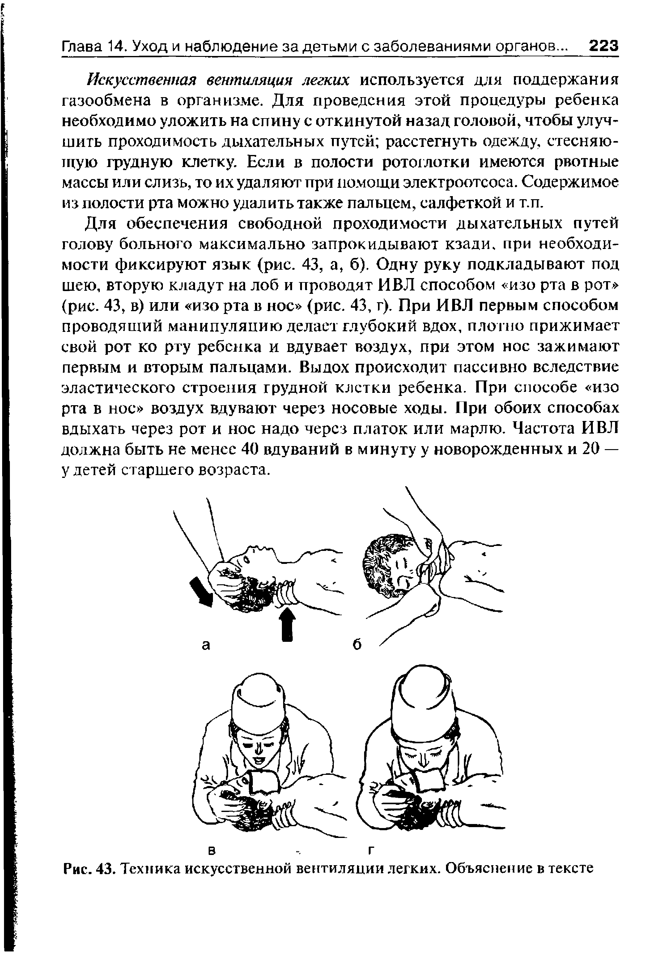 Рис. 43. Техника искусственной вентиляции легких. Объяснение в тексте...