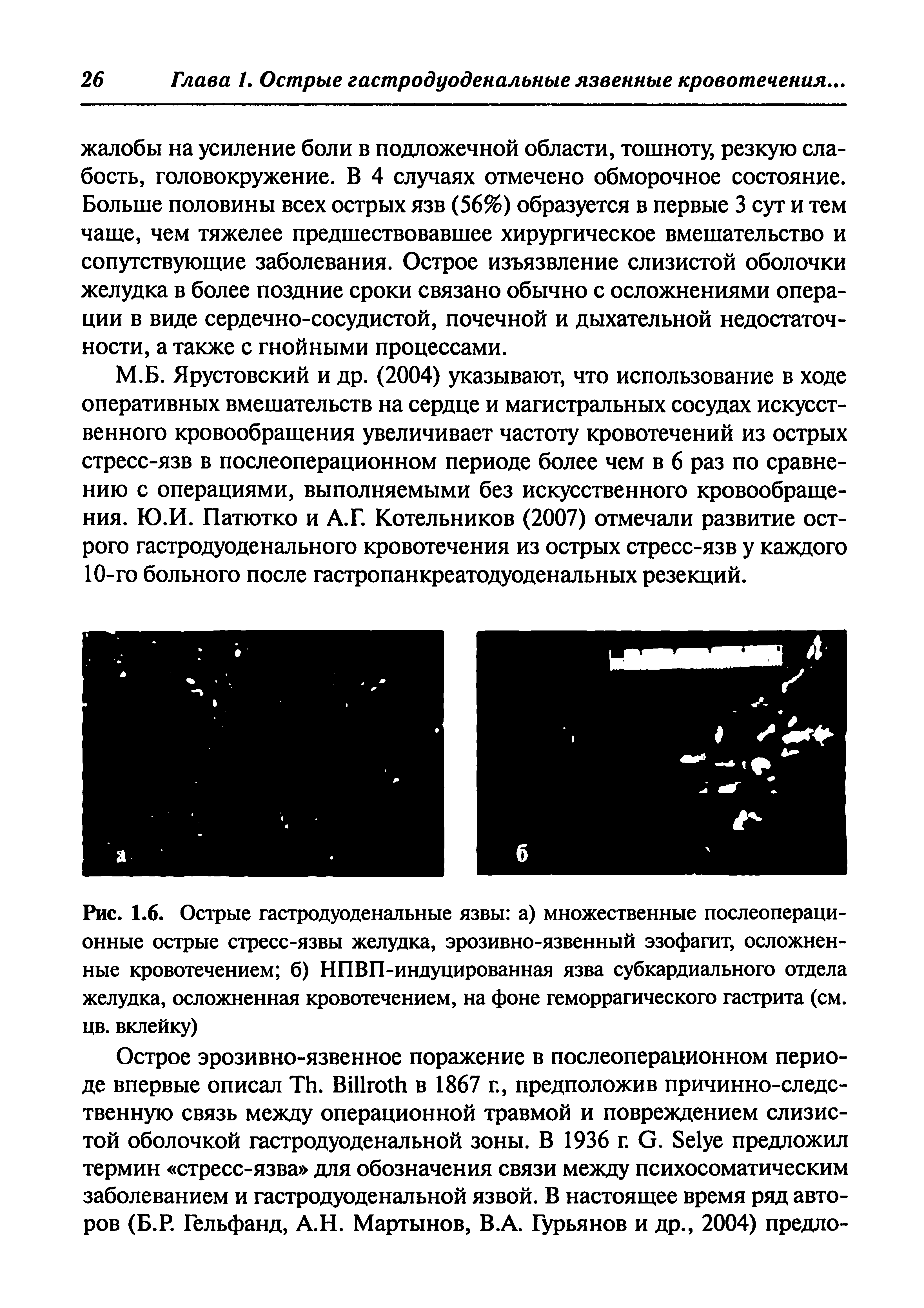 Рис. 1.6. Острые гастродуоденальные язвы а) множественные послеоперационные острые стресс-язвы желудка, эрозивно-язвенный эзофагит, осложненные кровотечением б) НПВП-индуцированная язва субкардиального отдела желудка, осложненная кровотечением, на фоне геморрагического гастрита (см. цв. вклейку)...