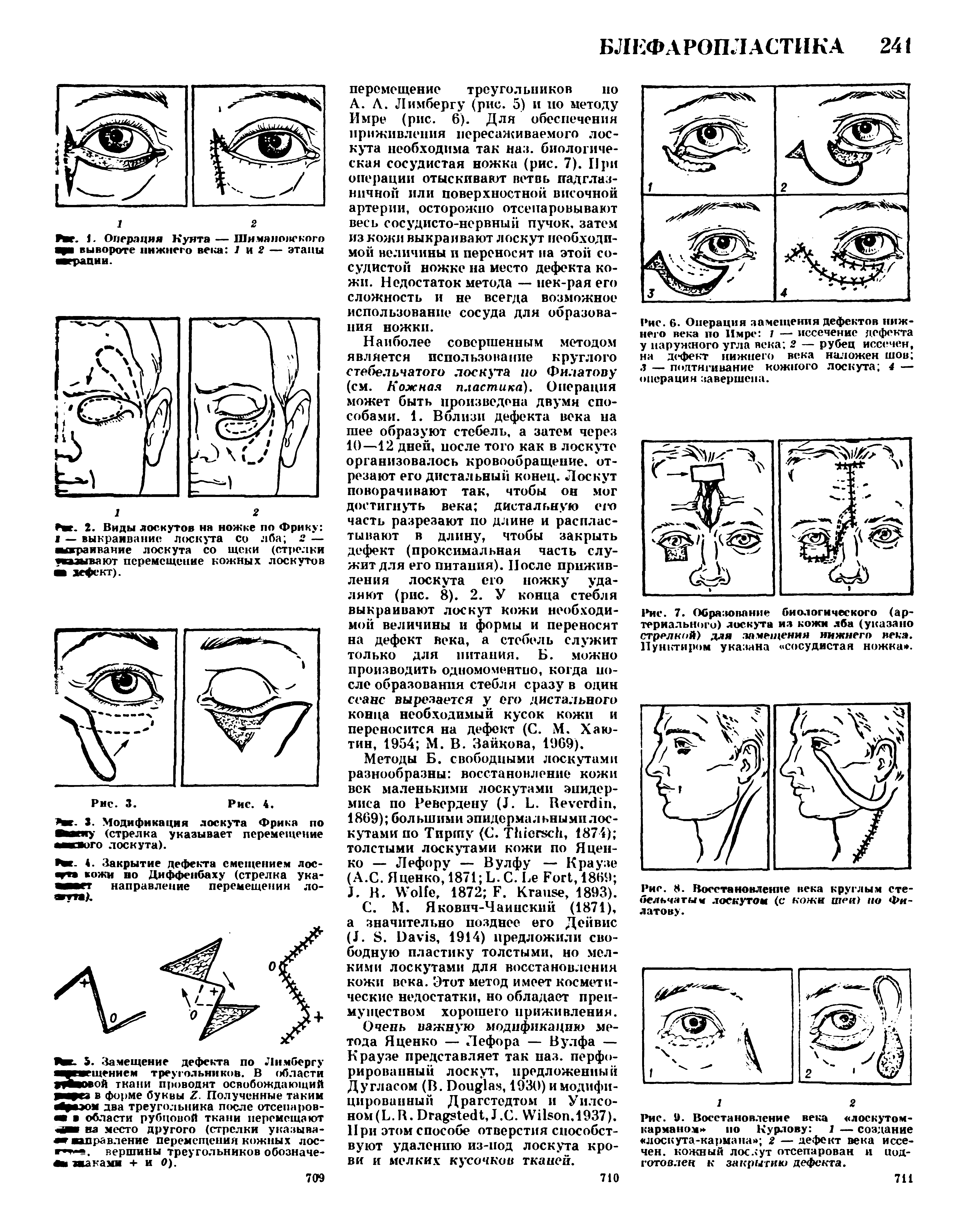 Рис. 7. Образование биологического (артериального) лоскута из кожи лба (указано стрелкой) для замещения нижнего века. Пунктиром указана сосудистая ножка. ...