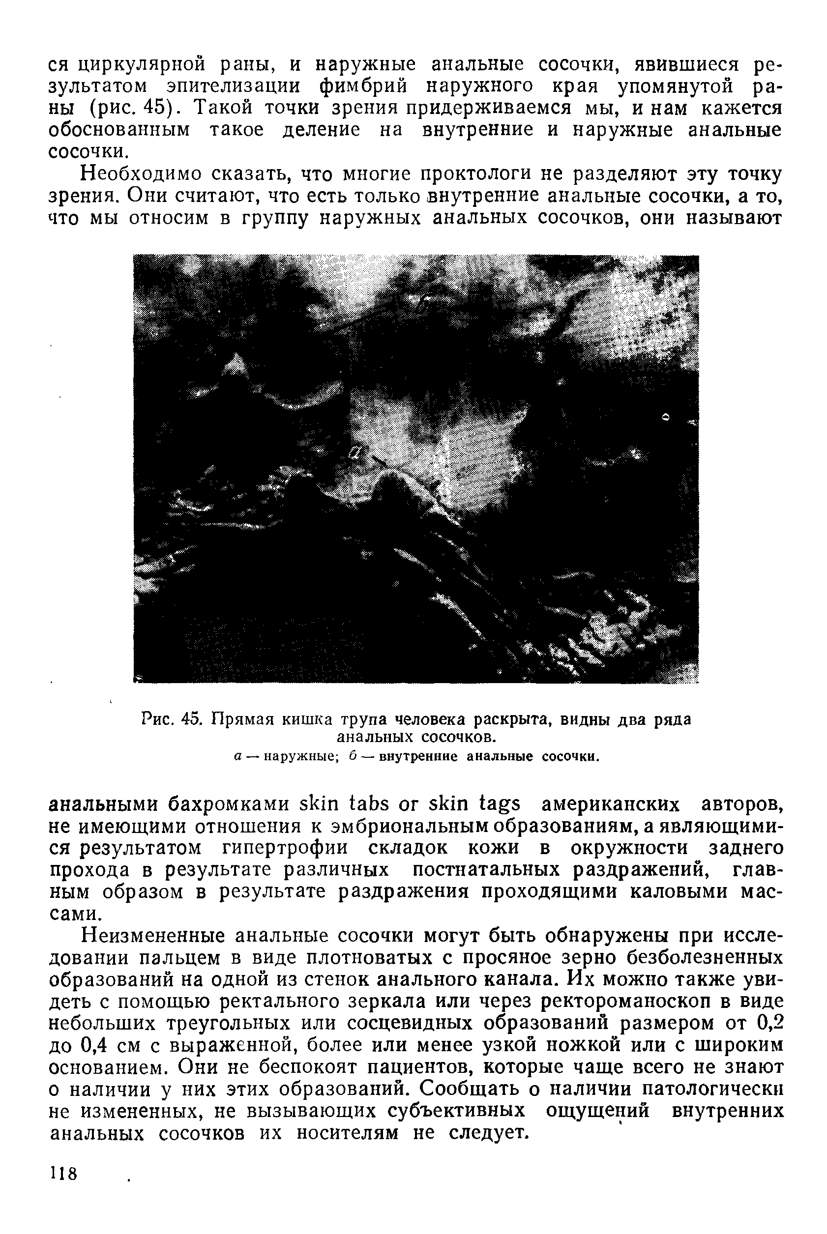 Рис. 45. Прямая кишка трупа человека раскрыта, видны два ряда анальных сосочков.