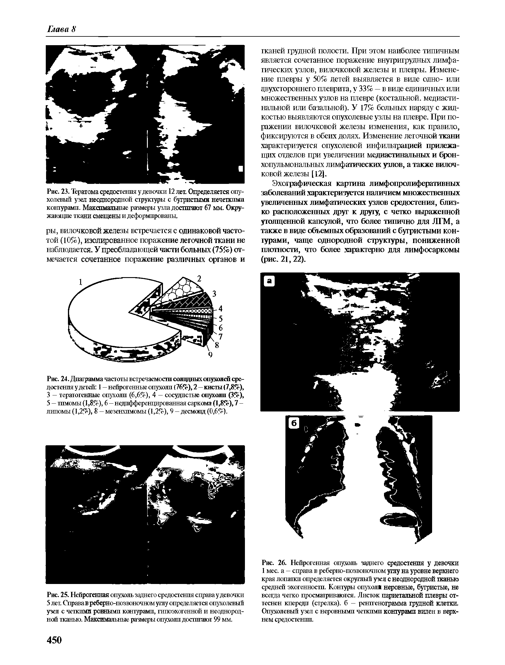 Рис. 24. Диаграмма частоты встречаемости солидных опухолей средостения у детей 1 — нейрогенные опухоли ( 76%), 2—кисты ( 7,8%), 3 — тератогенные опухоли (6,6%), 4 — сосудистые опухоли (3%), 5 — тимомы (1,8%), 6—недифференцированная саркома (1,8%), 7 -липомы (1,2%), 8 — мезенхпмомы (1,2%), 9 — десмоцд (0,6%).
