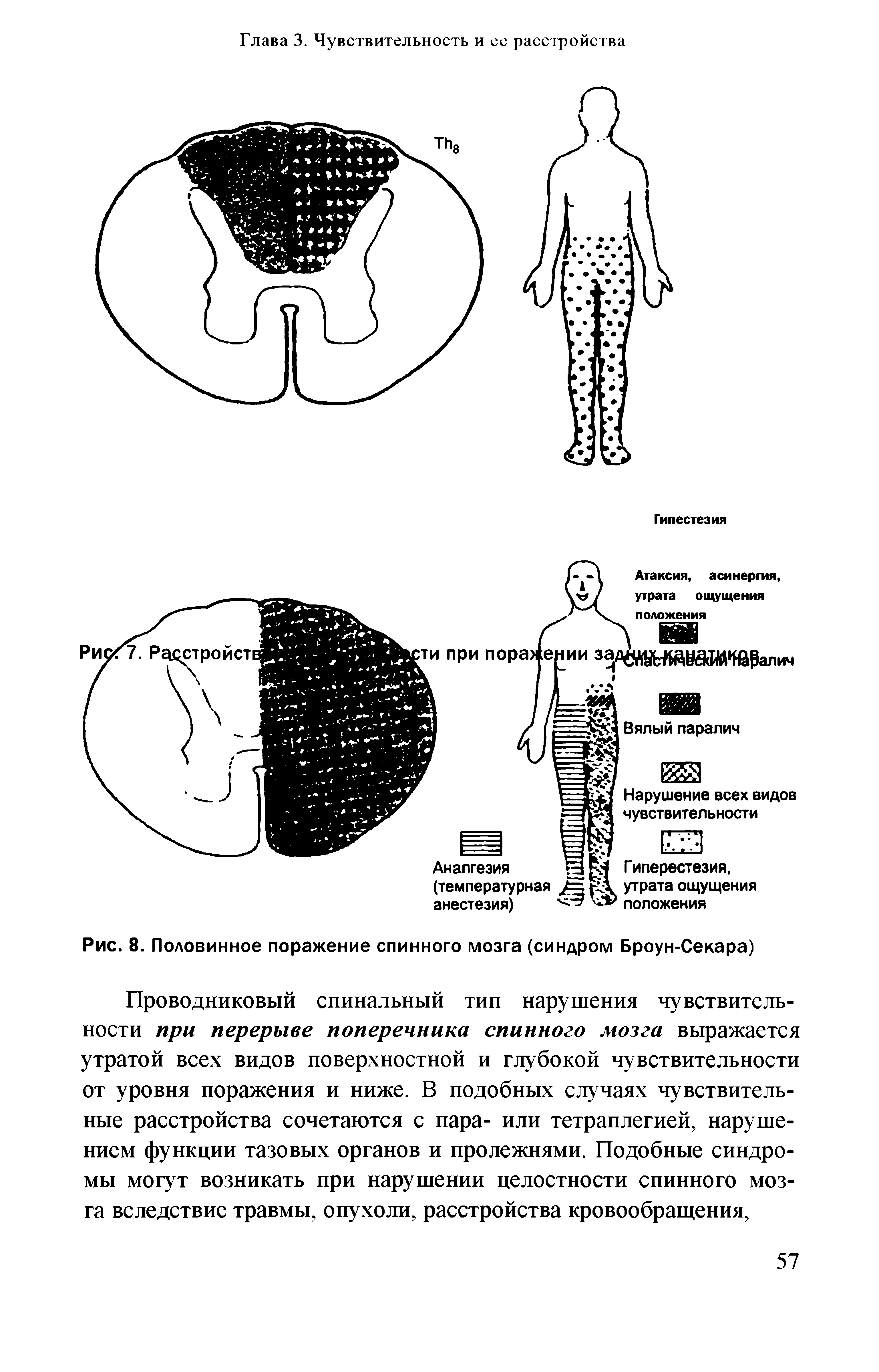 Рис. 8. Половинное поражение спинного мозга (синдром Броун-Секара)...