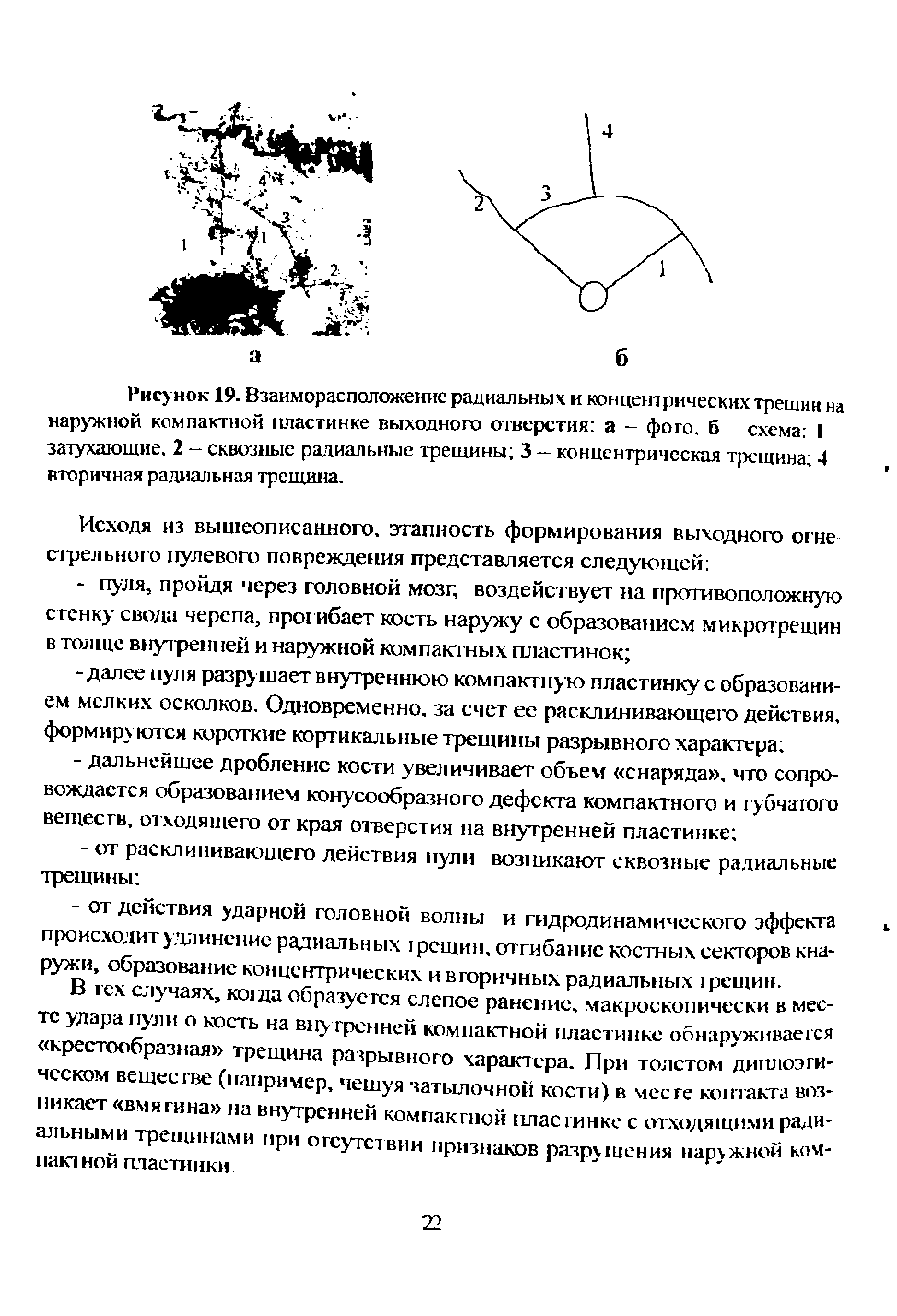 Рисунок 19. Взаиморасположение радиальных и концентрических трещин на наружной компактной пластинке выходного отверстия а - фото, б схема I затухающие. 2 - сквозные радиальные трещины 3 - концентрическая трещина 4 вторичная радиальная трещина.