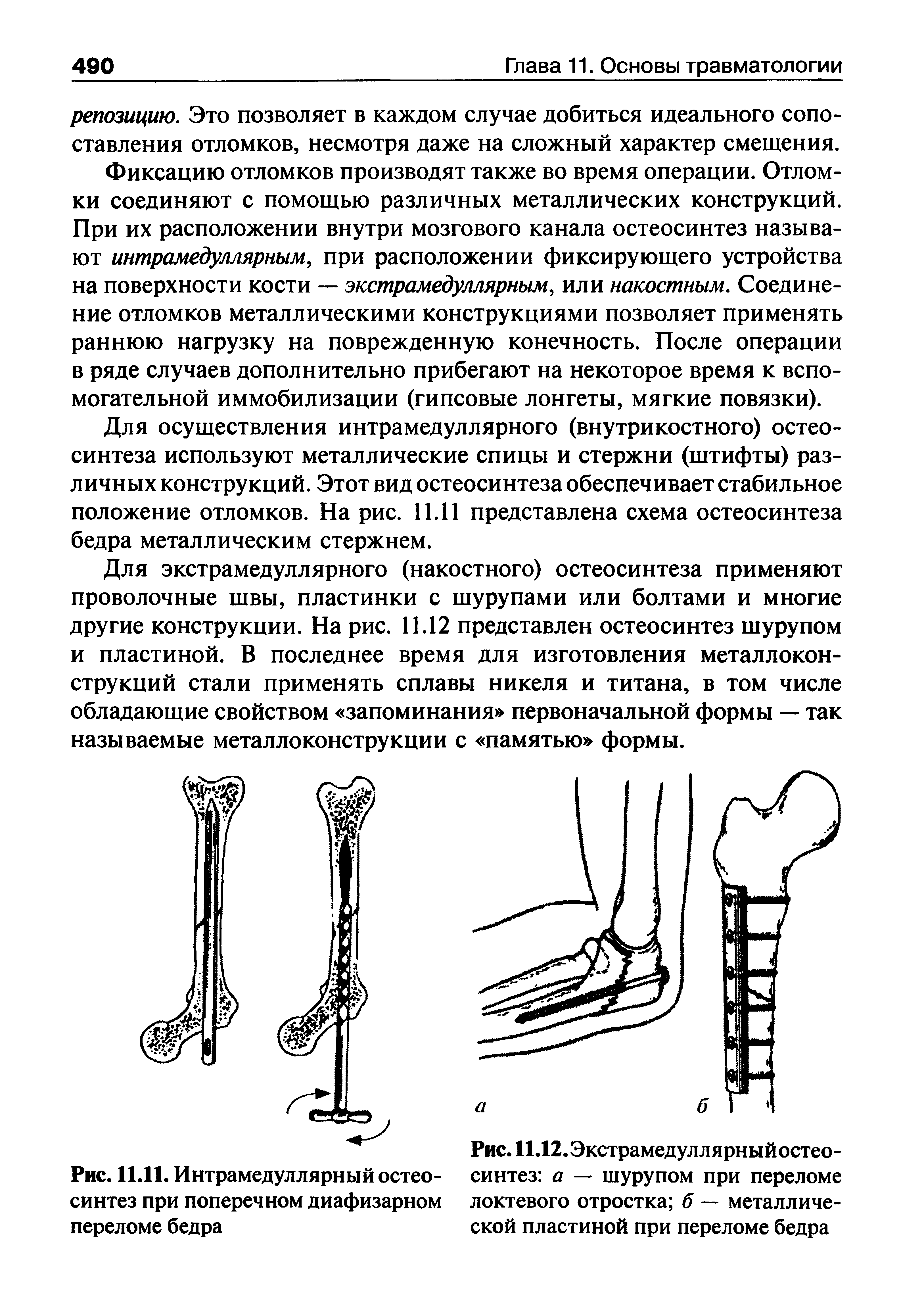Рис. 11.12. Экстрамедуллярныйостео-синтез а — шурупом при переломе локтевого отростка б — металлической пластиной при переломе бедра...