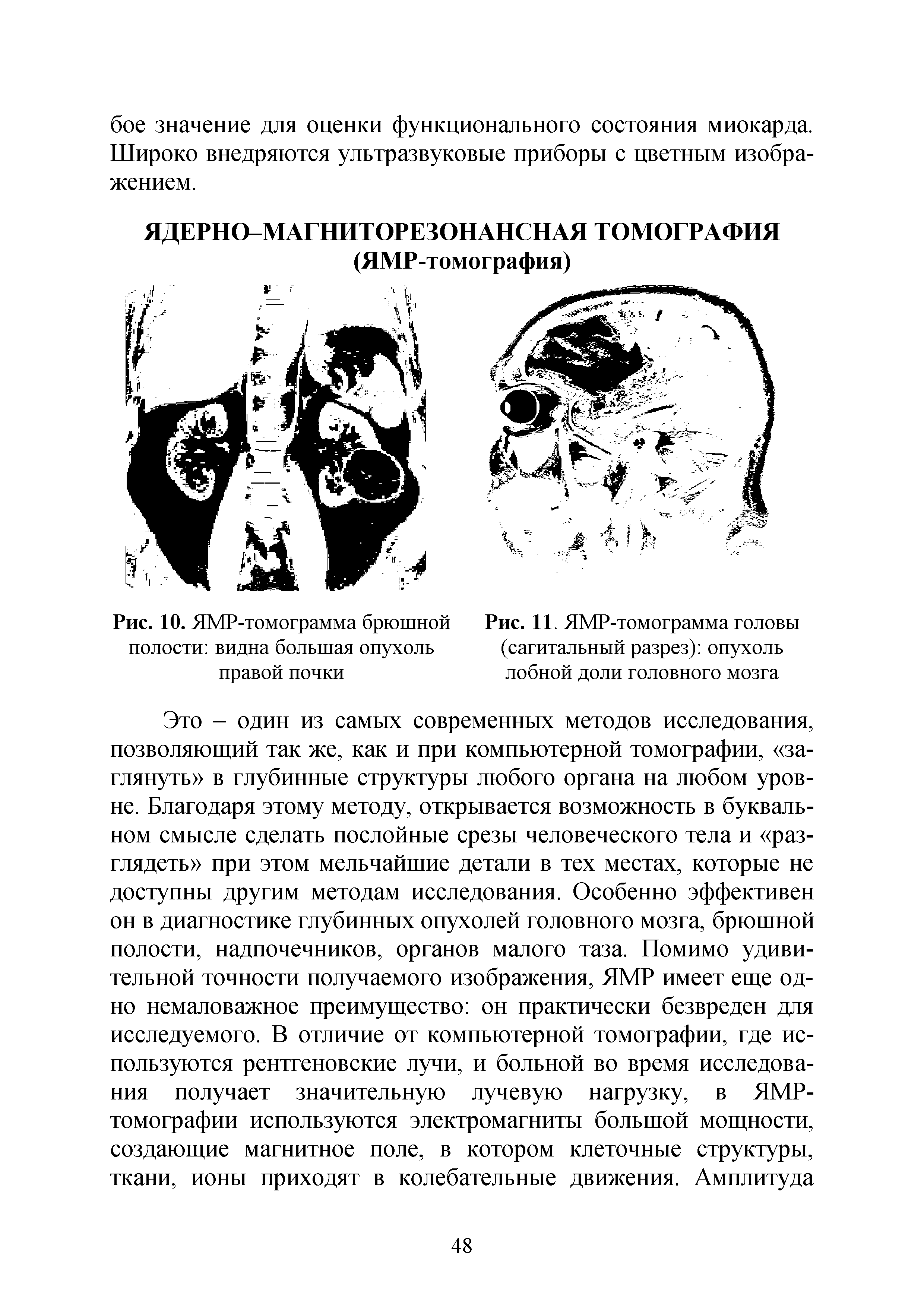 Рис. 11. ЯМР-томограмма головы (сагитальный разрез) опухоль лобной доли головного мозга...