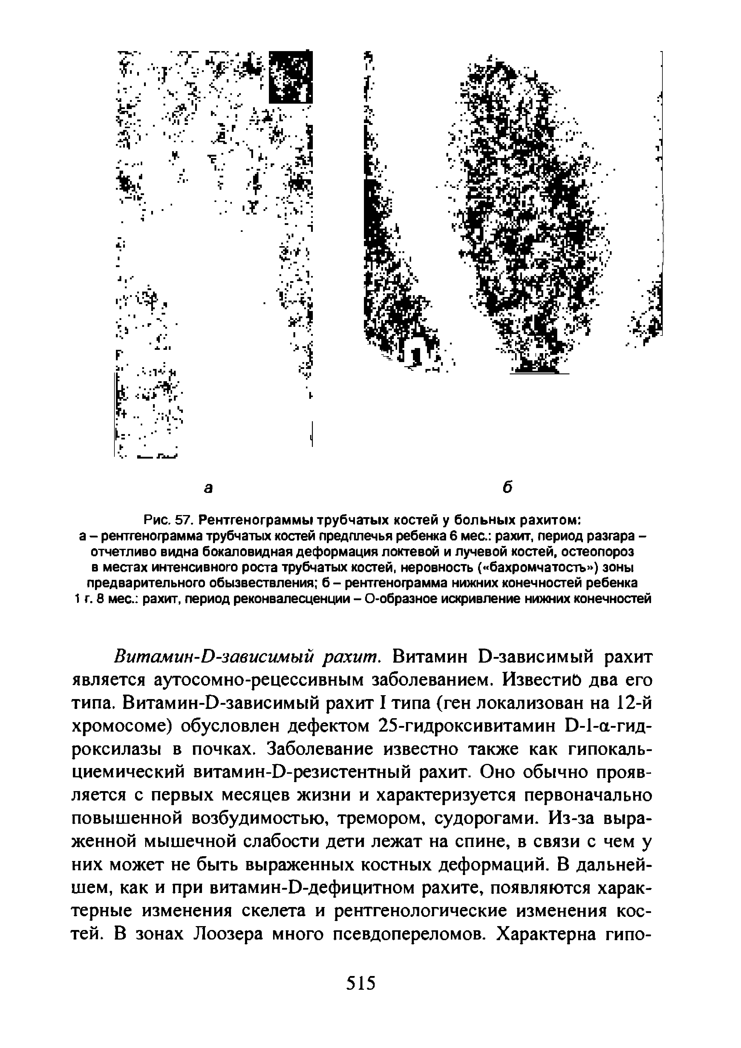 Рис. 57. Рентгенограммы трубчатых костей у больных рахитом а - рентгенограмма трубчатых костей предплечья ребенка 6 мес. рахит, период разгара -отчетливо видна бокаловидная деформация локтевой и лучевой костей, остеопороз в местах интенсивного роста трубчатых костей, неровность ( бахромчатость ) зоны предварительного обызвествления б - рентгенограмма нижних конечностей ребенка 1 г. 8 мес. рахит, период реконвалесценции - О-образное искривление нижних конечностей...