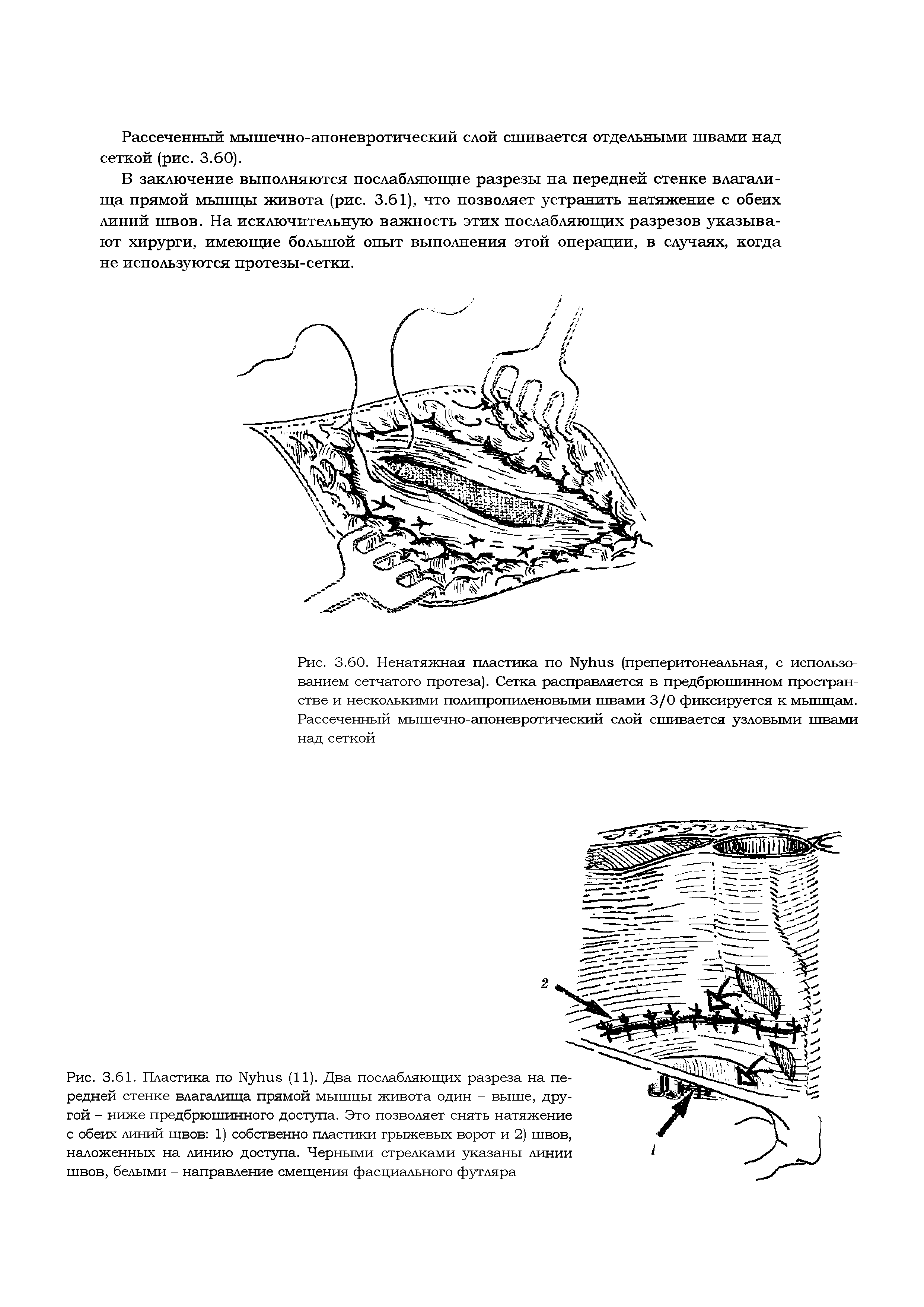 Рис. 3.60. Ненатяжная пластика по Иуйиз (преперитонеальная, с использованием сетчатого протеза). Сетка расправляется в предбрюшинном пространстве и несколькими полипропиленовыми швами 3/0 фиксируется к мышцам. Рассеченный мышечно-апоневротический слой сшивается узловыми швами над сеткой...