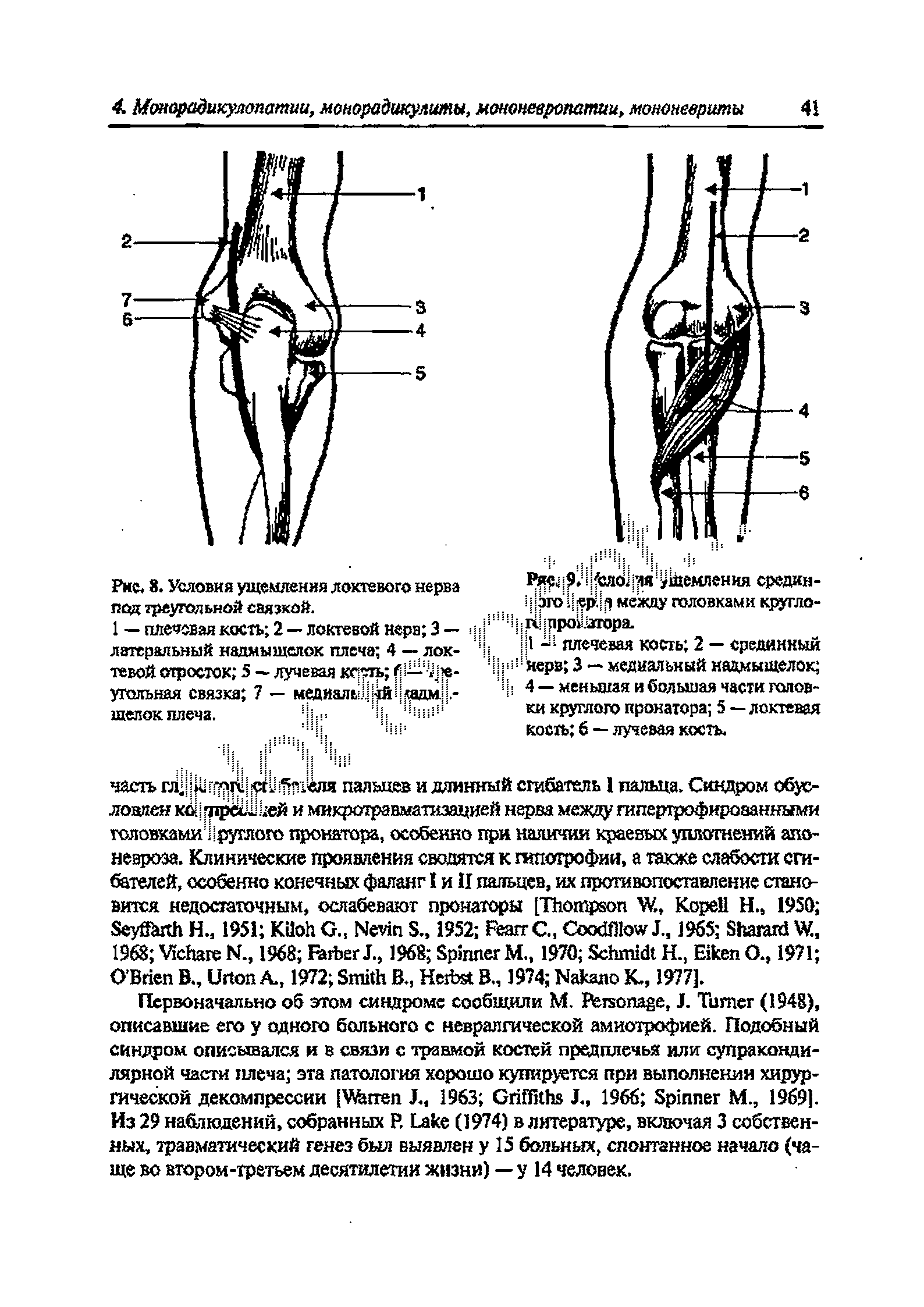 Рис. 8. Условия ущемления локтевого нерва под треугольной связкой.