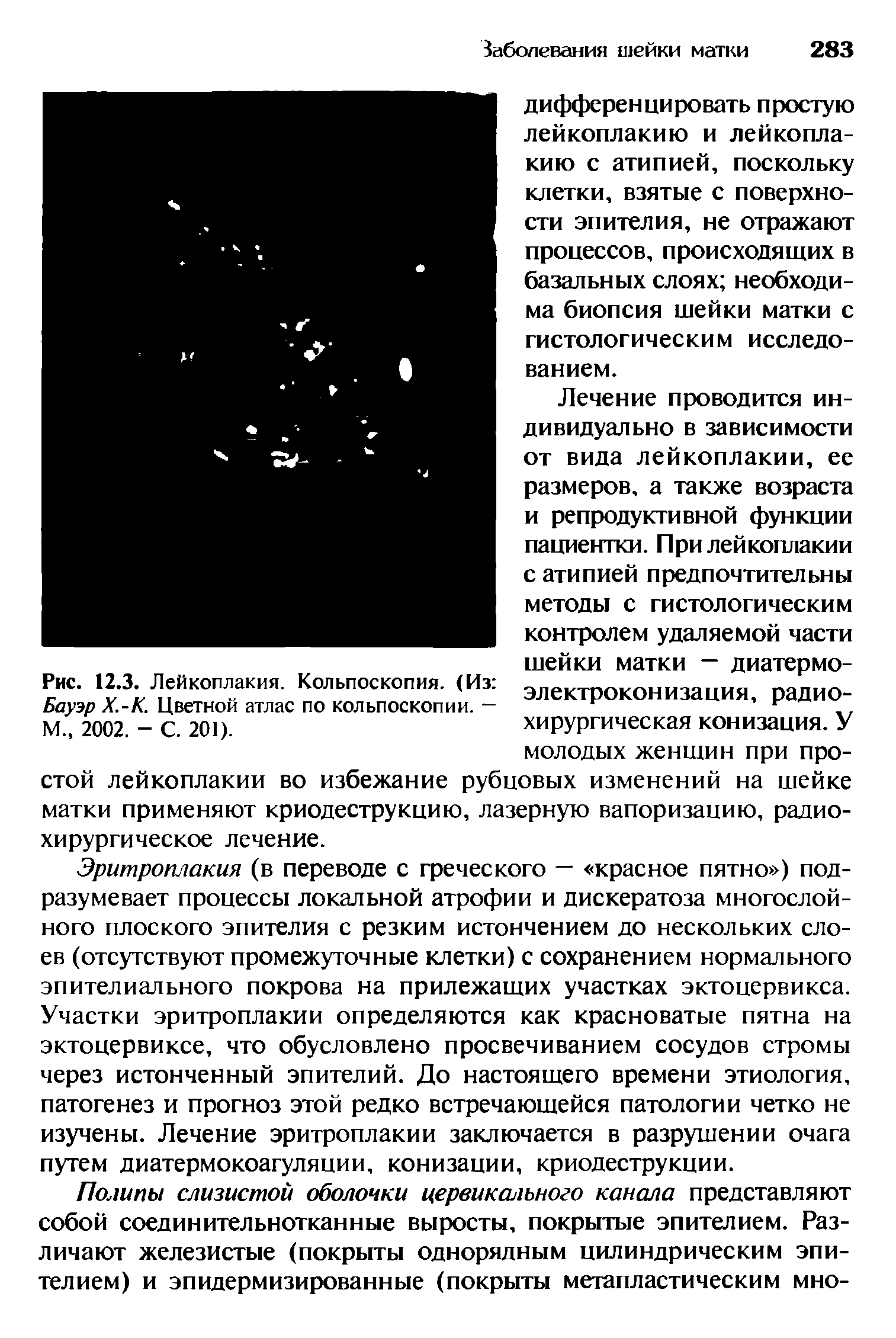 Рис. 12.3. Лейкоплакия. Кольпоскопия. (Из Бауэр Х.-К. Цветной атлас по кольпоскопии. -М., 2002. - С. 201).