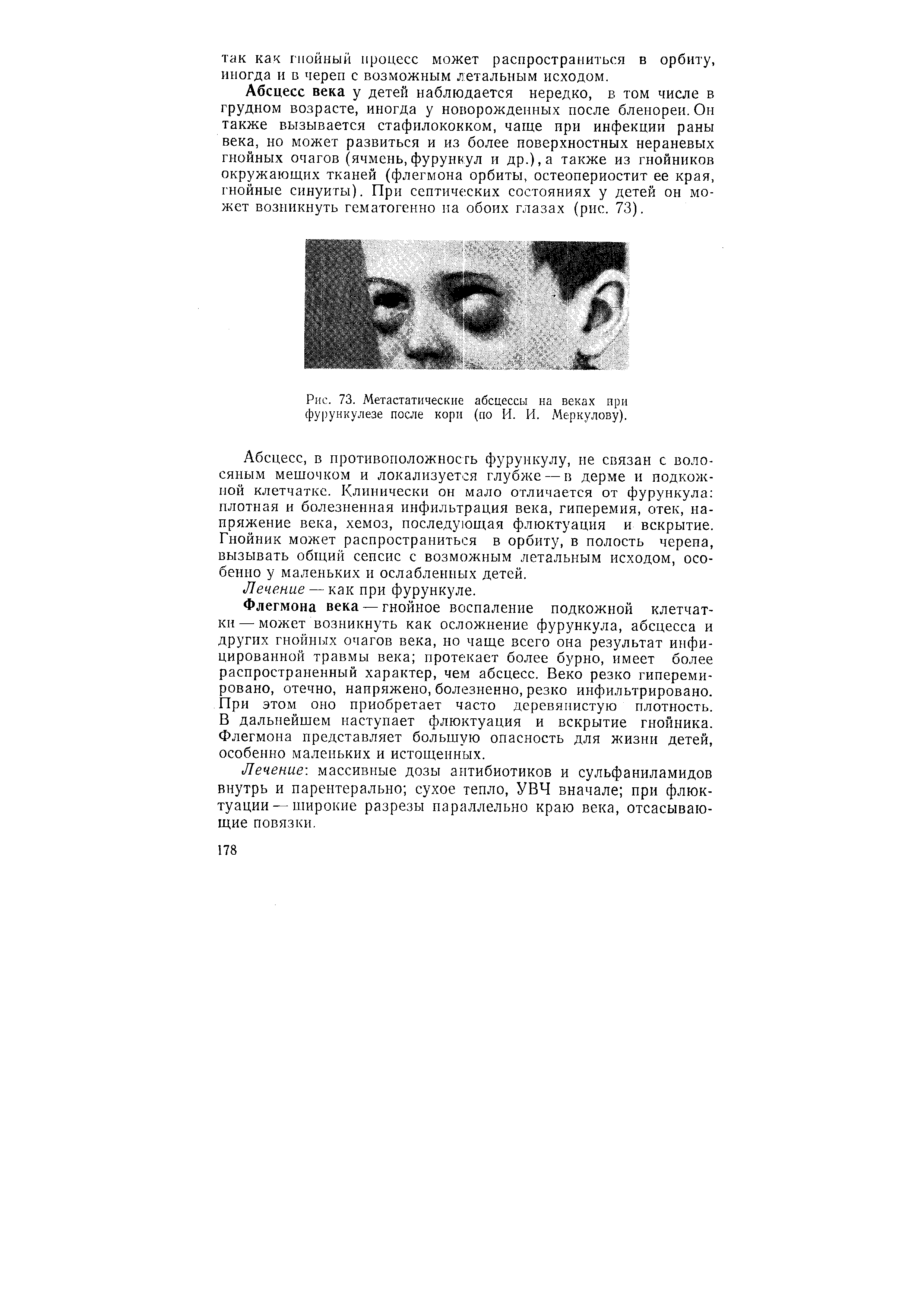 Рис. 73. Метастатические абсцессы на веках ири фурункулезе после кори (по И. И. Меркулову).