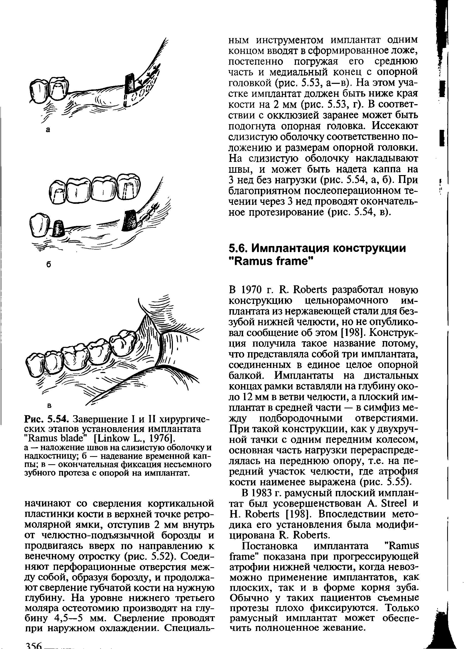 Рис. 5.54. Завершение I и II хирургических этапов установления имплантата "R " [L L., 1976].