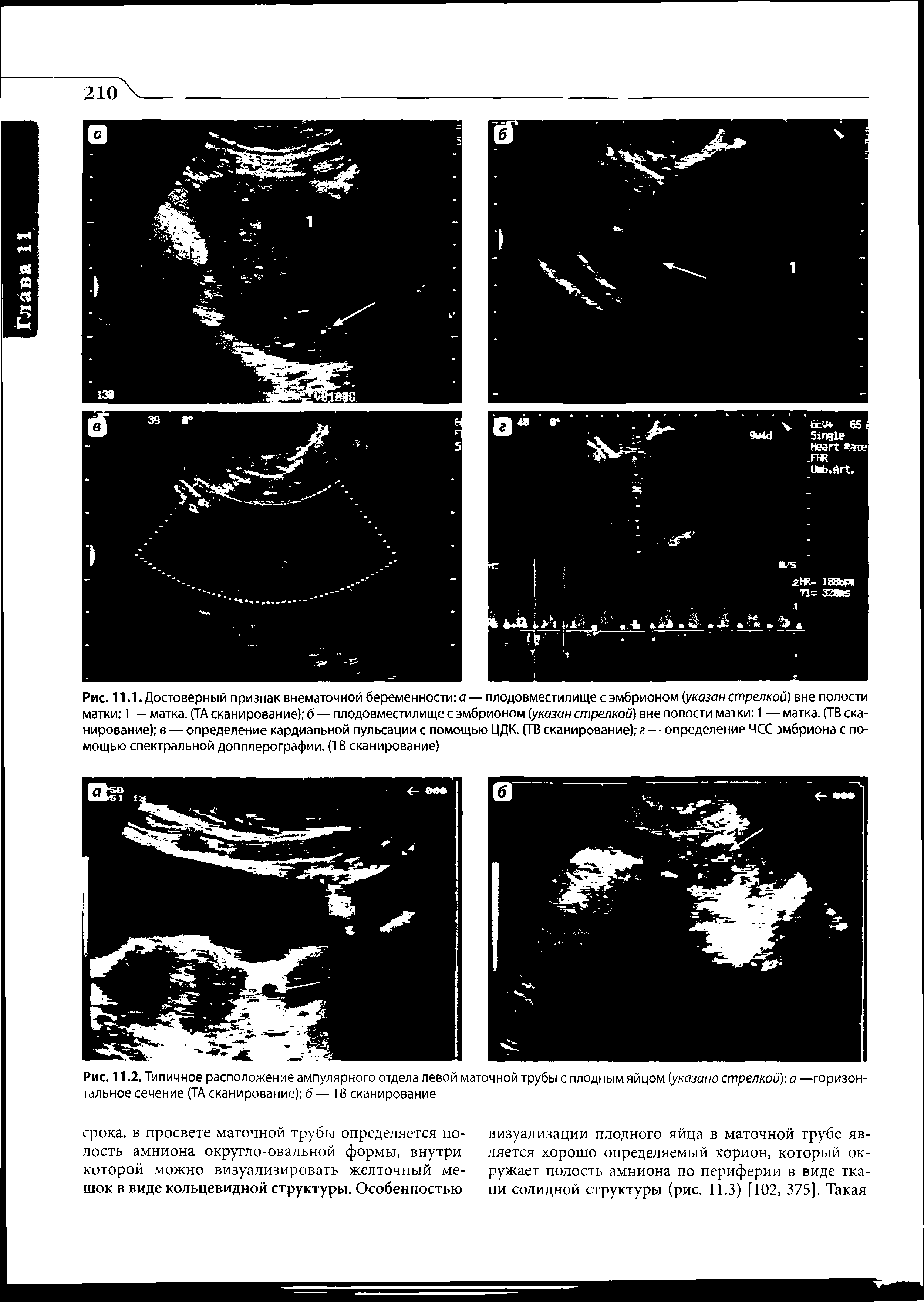 Рис. 11.1. Достоверный признак внематочной беременности а — плодовместилище с эмбрионом (указан стрелкой) вне полости матки 1 — матка. (ТА сканирование) б— плодовместилище с эмбрионом (указан стрелкой) вне полости матки 1 — матка. (ТВ сканирование) в — определение кардиальной пульсации с помощью ЦДК. (ТВ сканирование) г — определение ЧСС эмбриона с помощью спектральной допплерографии. (ТВ сканирование)...