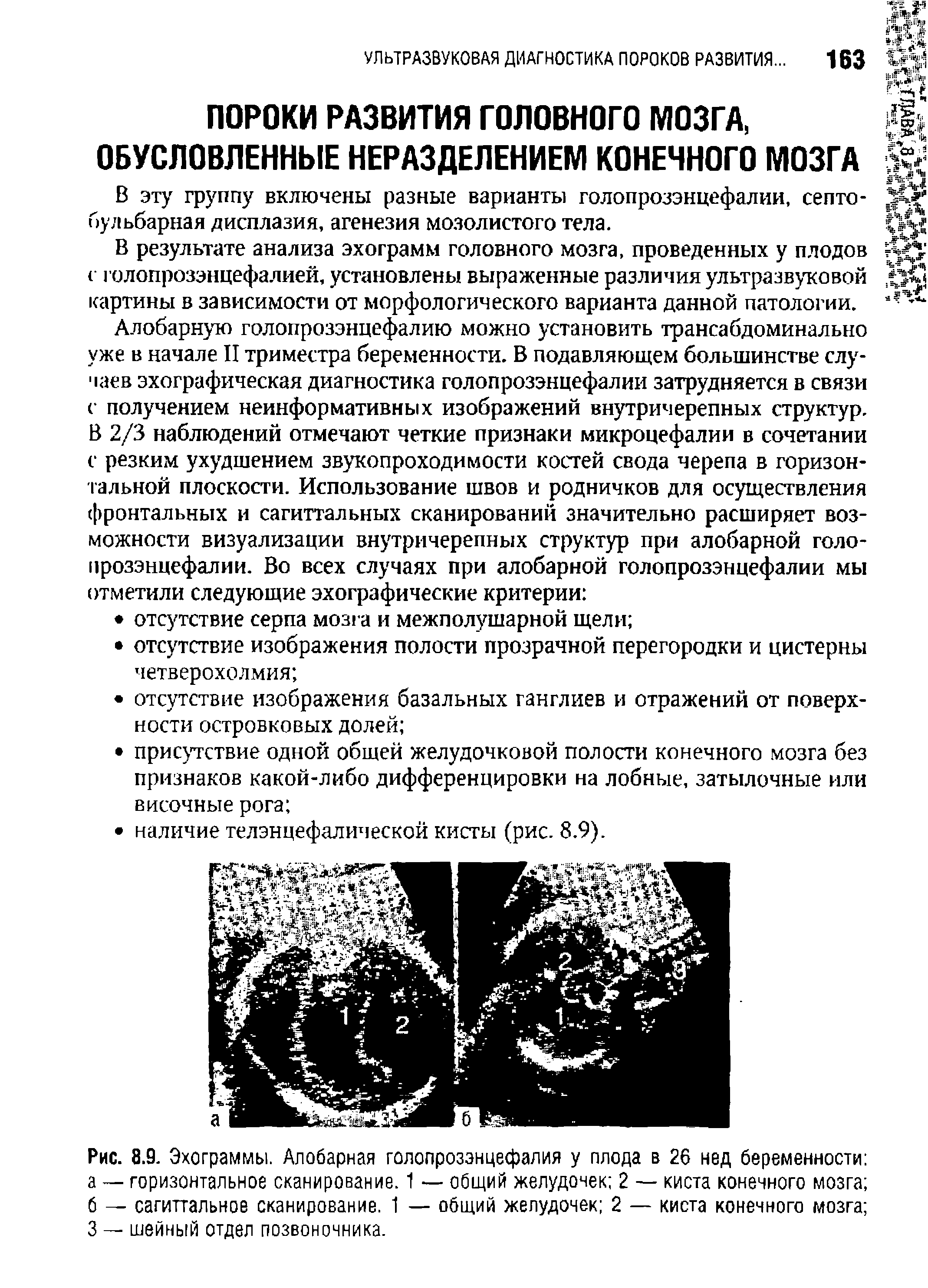 Рис. 8.9. Эхограммы. Алобарная голопрозэнцефалия у плода в 26 нед беременности а — горизонтальное сканирование. 1 — общий желудочек 2 — киста конечного мозга б — сагиттальное сканирование. 1 — общий желудочек 2 — киста конечного мозга 3 — шейный отдел позвоночника.