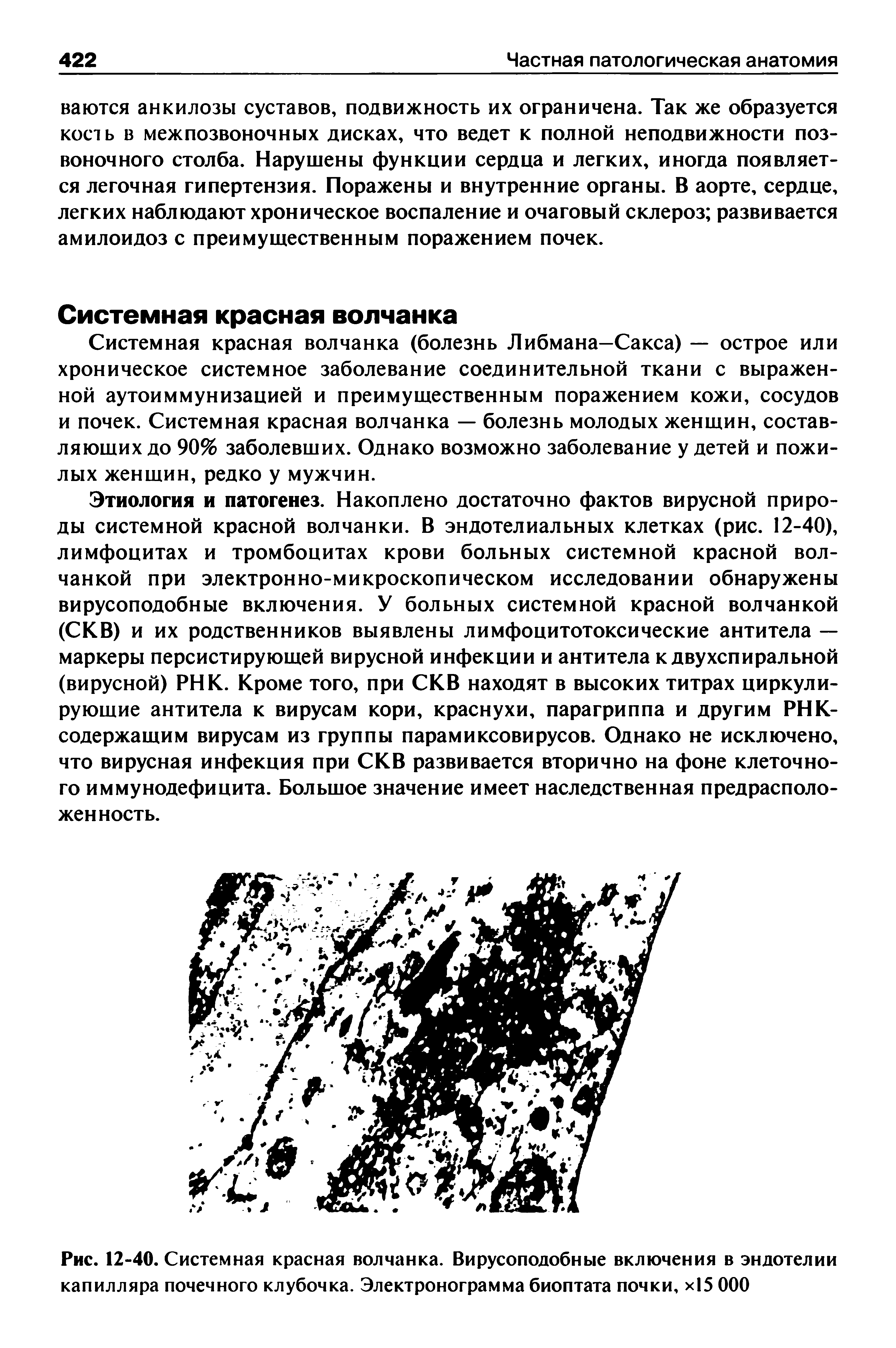 Рис. 12-40. Системная красная волчанка. Вирусоподобные включения в эндотелии капилляра почечного клубочка. Электронограмма биоптата почки, х 5 ООО...