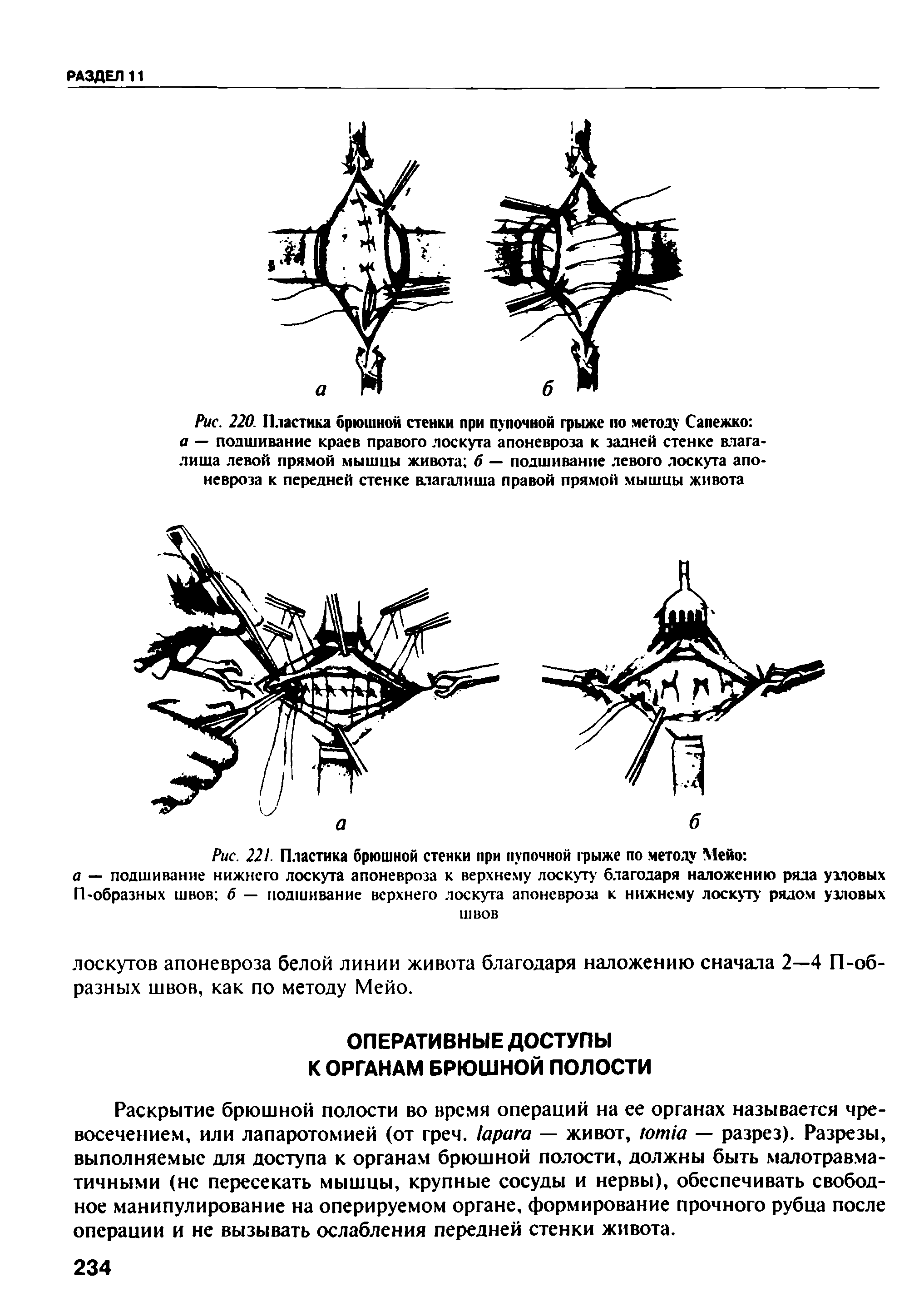 Рис. 221. Пластика брюшной стенки при пупочной грыже по метолу Мейо ...