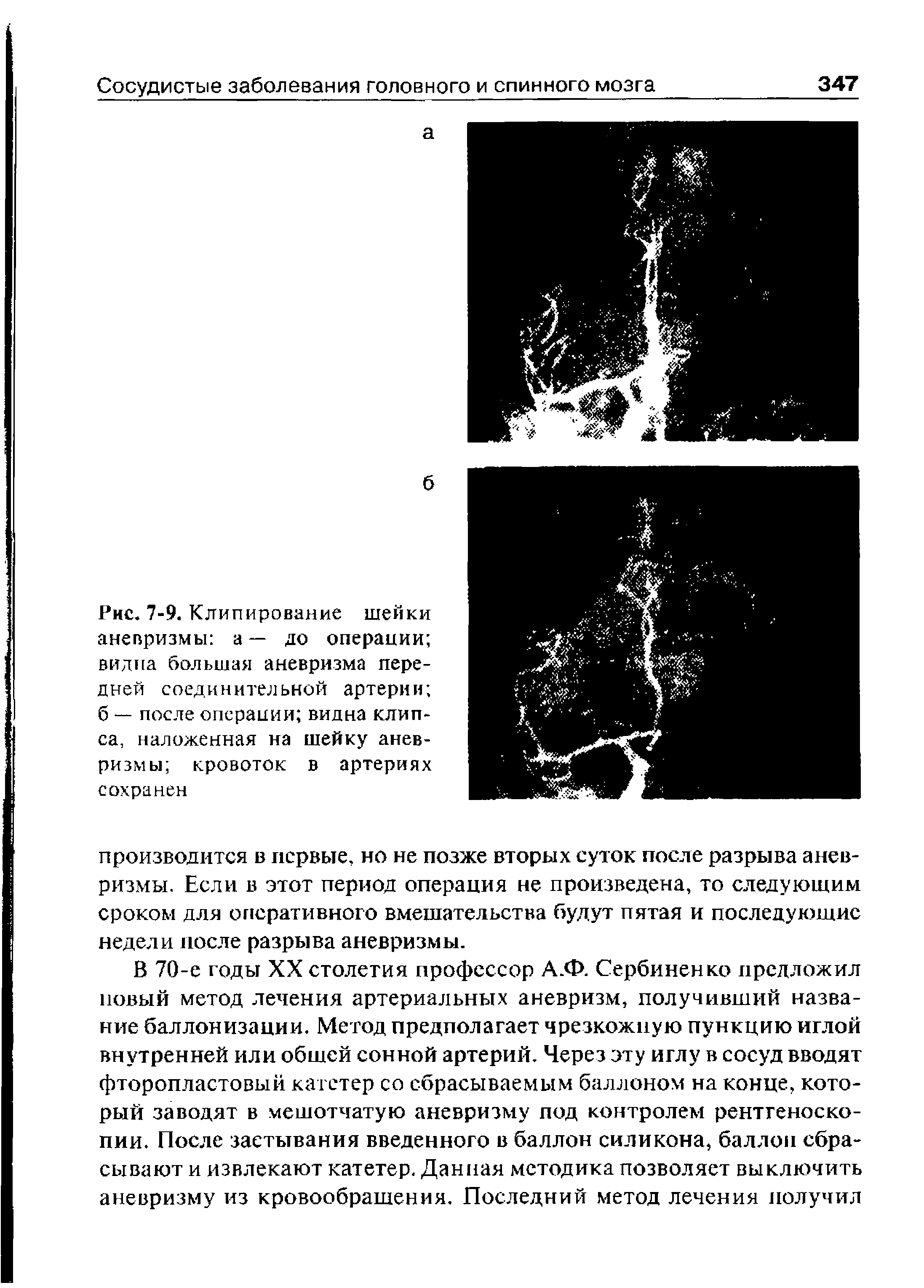 Рис. 7-9. Клипирование шейки аневризмы а — до операции видна большая аневризма передней соединительной артерии б — после операции видна клипса, наложенная на шейку аневризмы кровоток в артериях сохранен...
