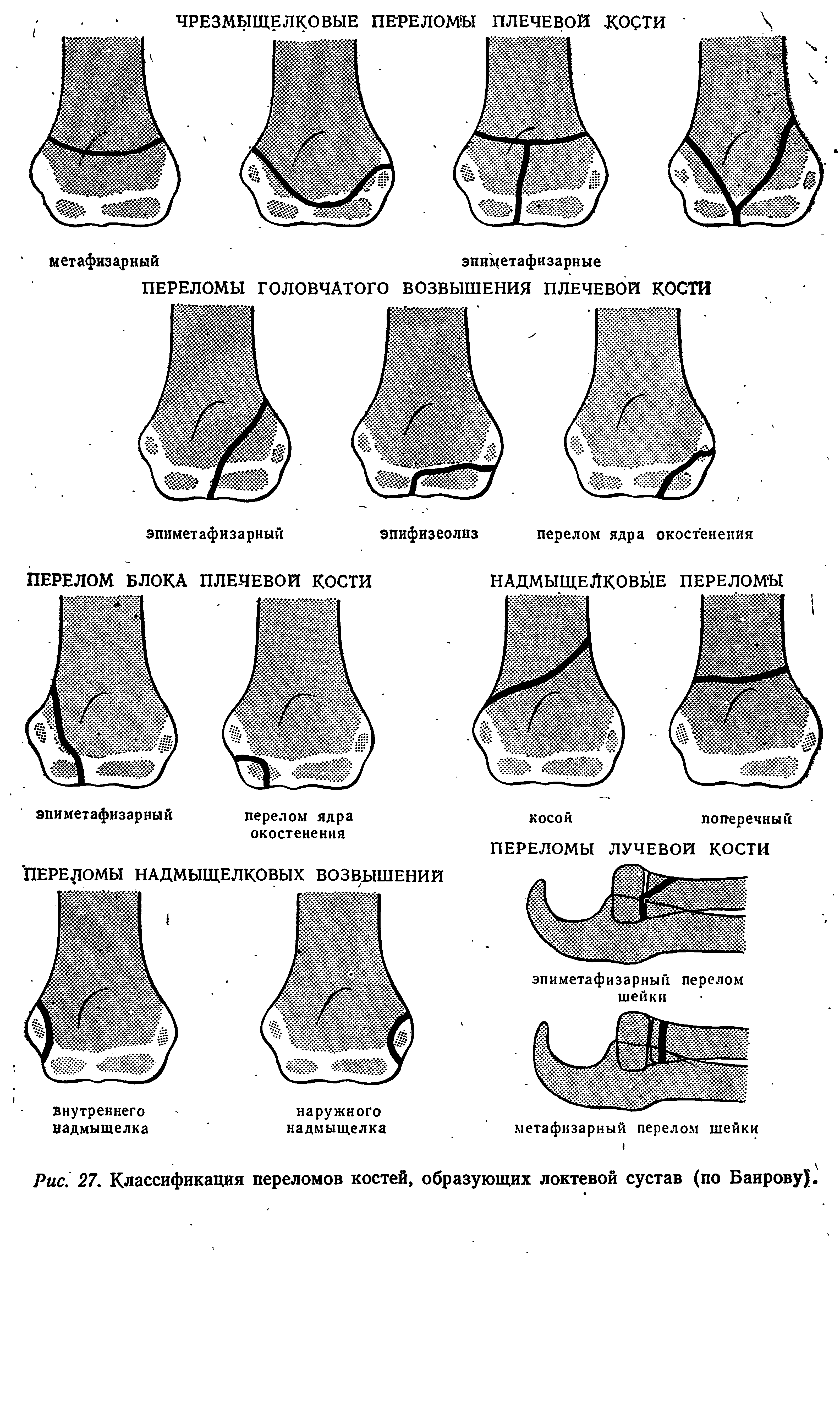 Рис. 27. Классификация переломов костей, образующих локтевой сустав (по Баирову).