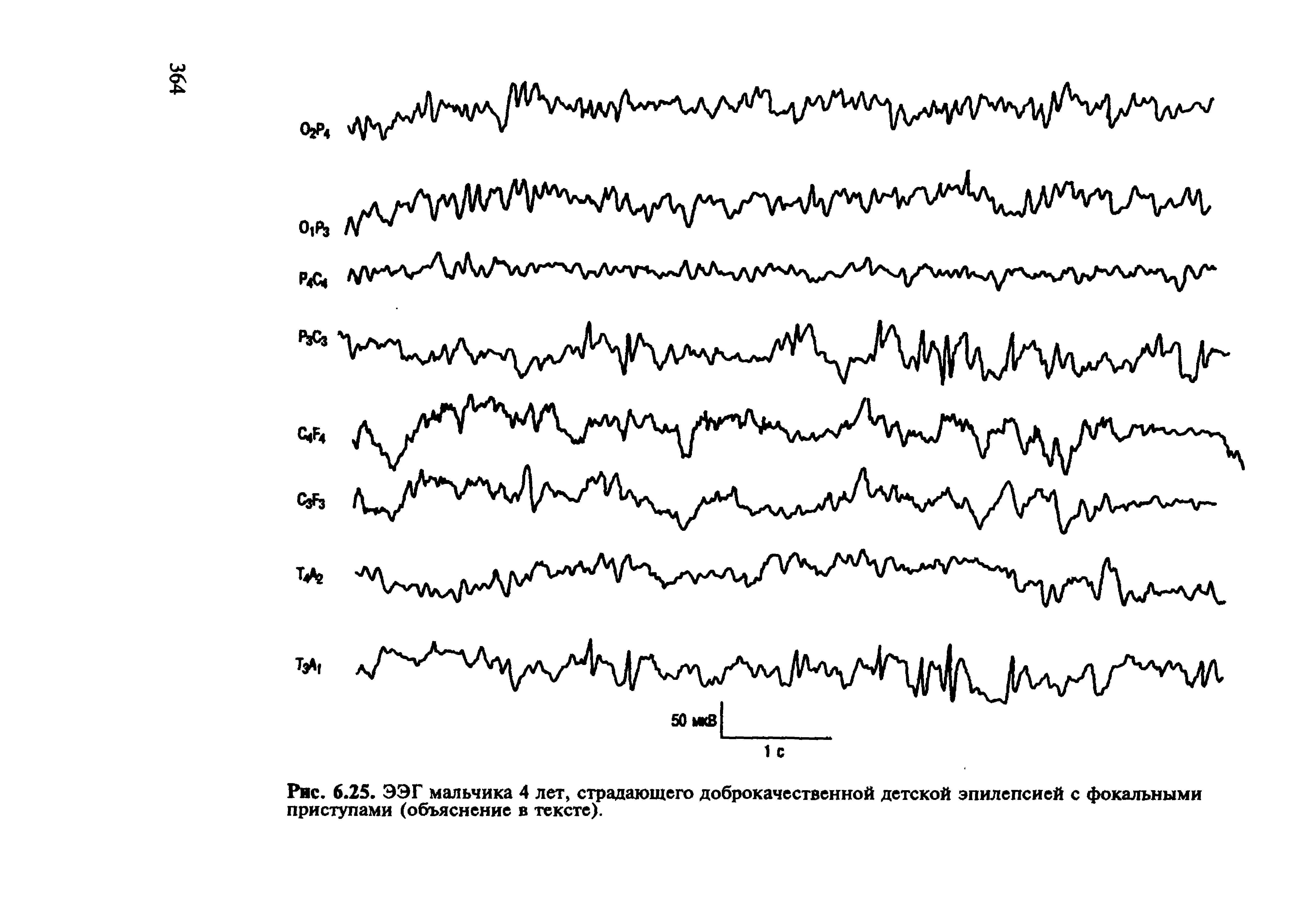Рис. 6.25. ЭЭГ мальчика 4 лет, страдающего доброкачественной детской эпилепсией с фокальными приступами (объяснение в тексте).