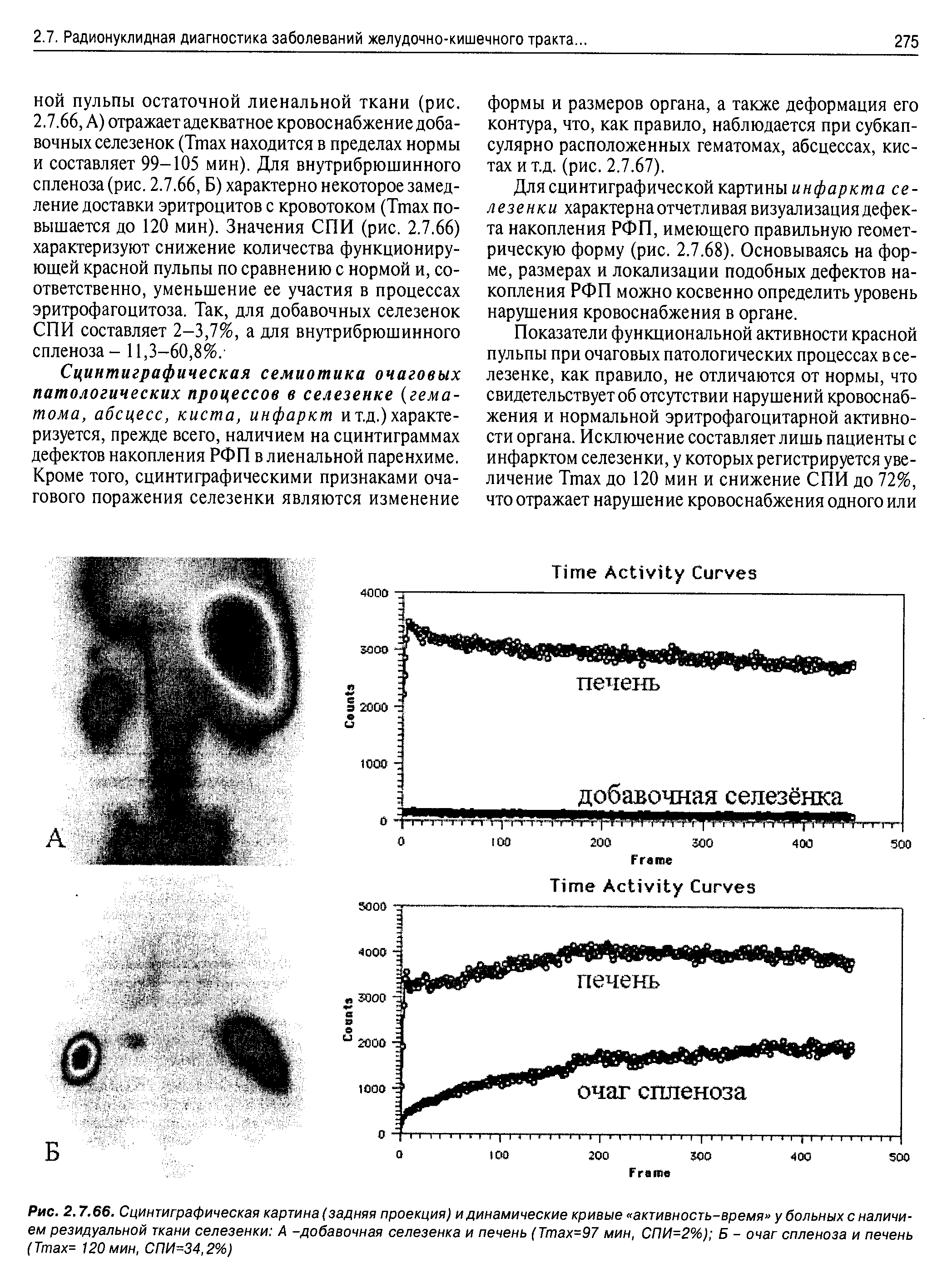 Рис. 2.7.66. Сцинтиграфическая картина (задняя проекция) и динамические кривые активность-время у больных с наличием резидуальной ткани селезенки Д -добавочная селезенка и печень (Ттах=97 мин, СПИ=2%) Б - очаг спленоза и печень (Ттах= 120 мин, СПИ=34,2%)...