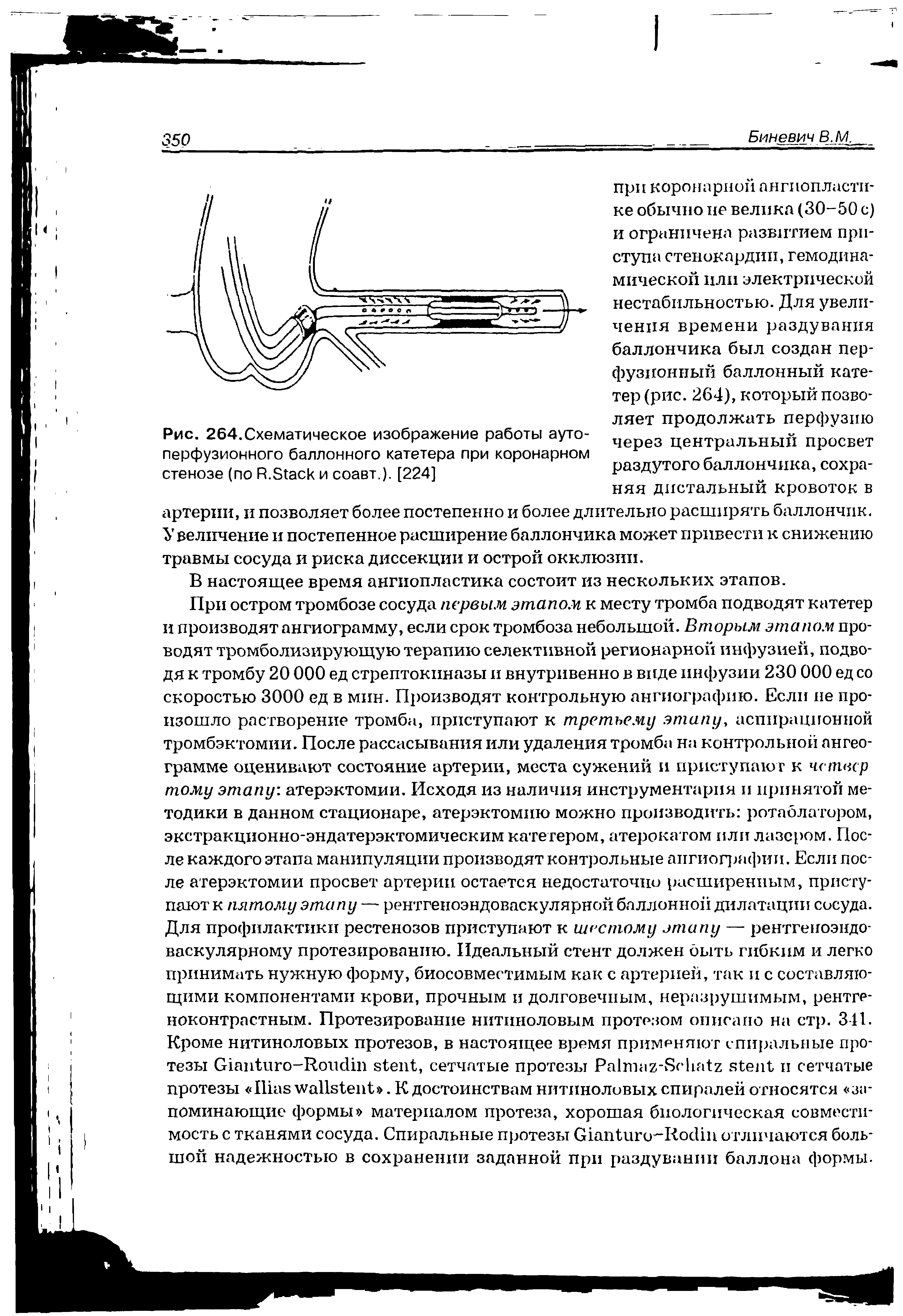 Рис. 264.Схематическое изображение работы аутоперфузионного баллонного катетера при коронарном стенозе (по R.S и соавт.). [224]...