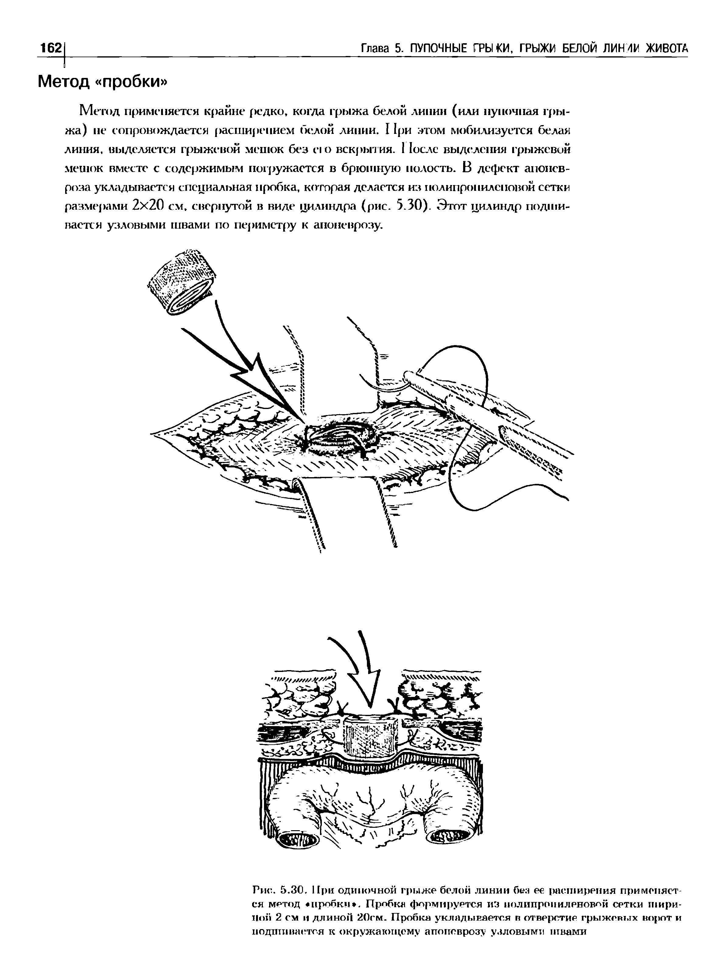 Рис. 5.30. При одиночной грыже белой линии без ее расширения применяется метод пробки . Пробка формируется из полипропиленовой сетки шириной 2 см и длиной 20см. Пробка укладывается в отверстие грыжевых ворот и подшивается к окружающему апоневрозу узловыми швами...