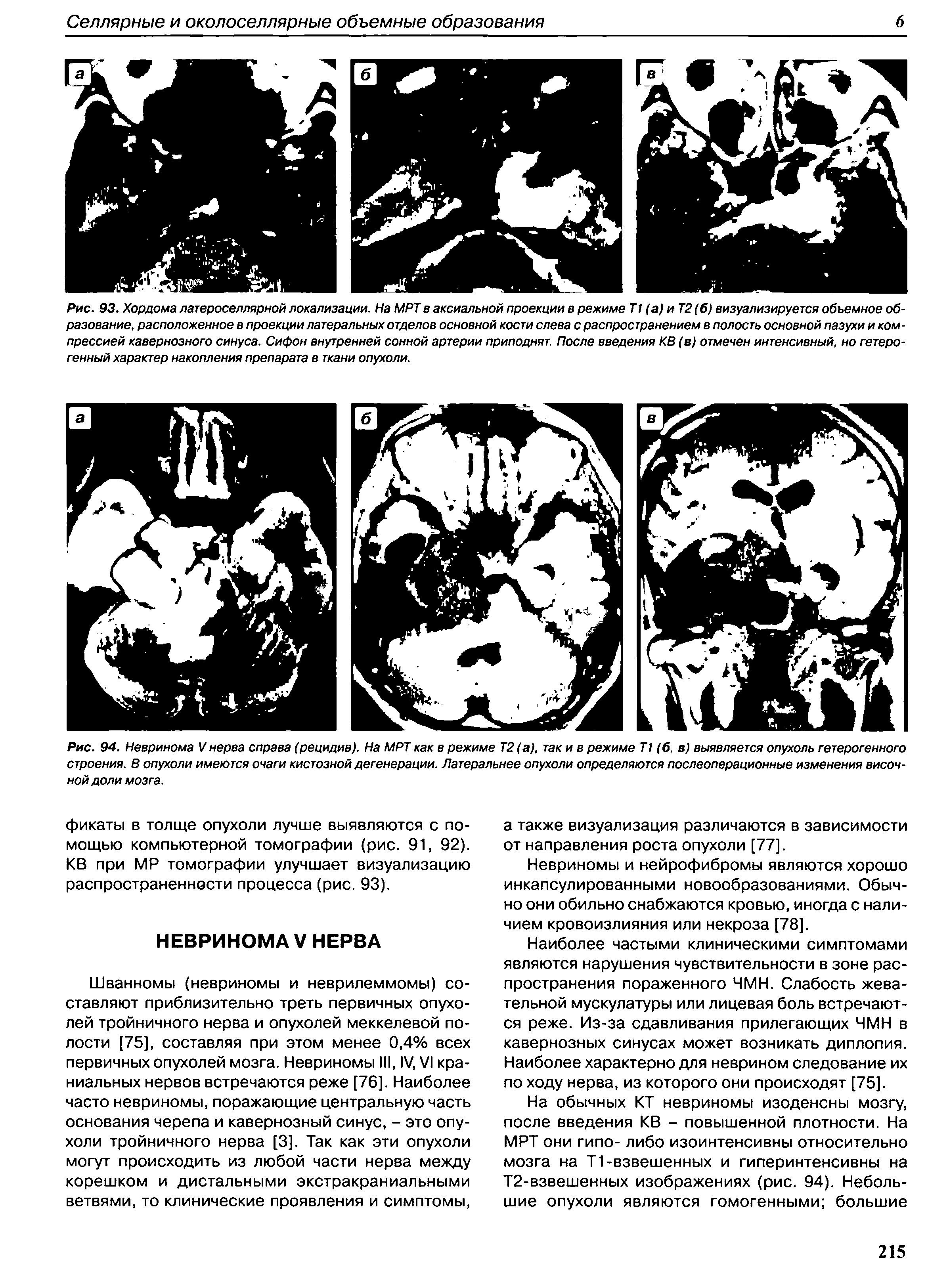 Рис. 94. Невринома V нерва справа (рецидив). На МРТ как в режиме Т2 (а), так и в режиме Т1 (б, в) выявляется опухоль гетерогенного строения. В опухоли имеются очаги кистозной дегенерации. Латеральнее опухоли определяются послеоперационные изменения височной доли мозга.