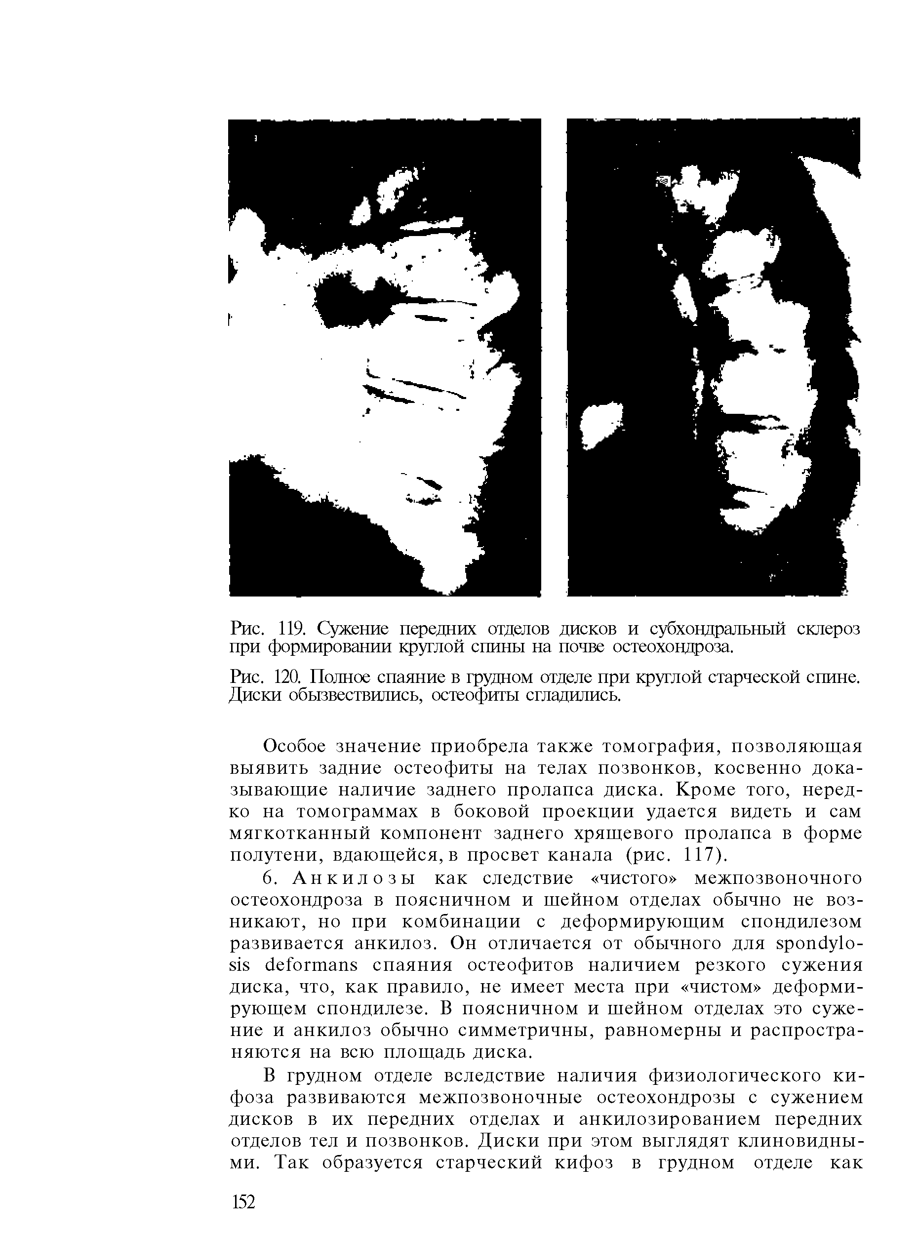 Рис. 120. Полное спаяние в грудном отделе при круглой старческой спине. Диски обызвествились, остеофиты сгладились.