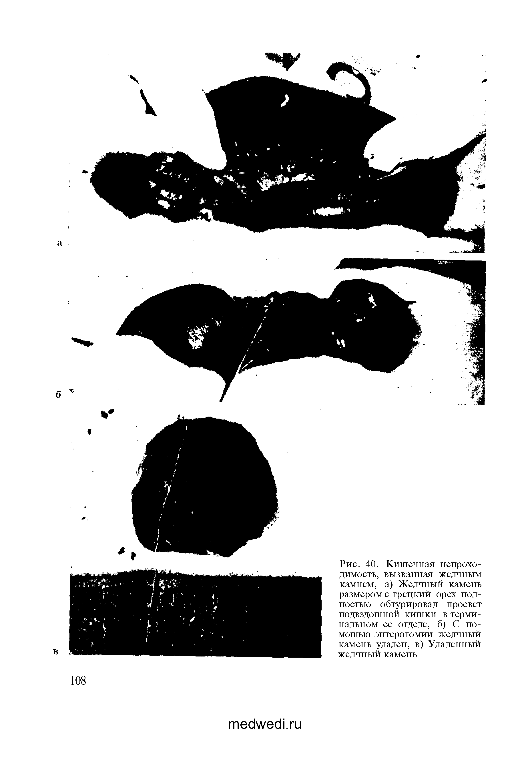 Рис. 40. Кишечная непроходимость, вызванная желчным камнем, а) Желчный камень размером с грецкий орех полностью обтурировал просвет подвздошной кишки в терминальном ее отделе, б) С помощью энтеротомии желчный камень удален, в) Удаленный желчный камень...