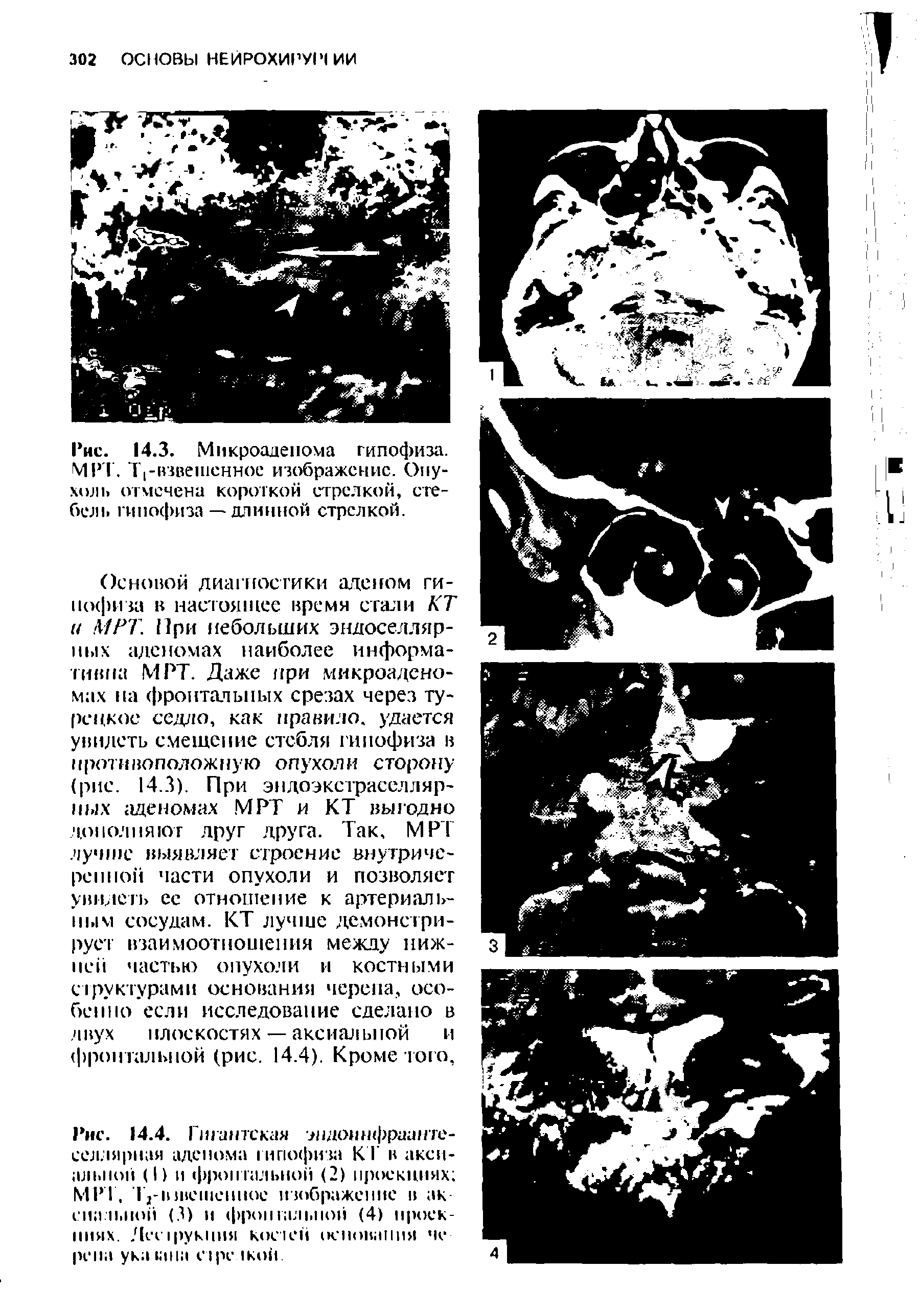 Рис. 14.3. Мнкроадепома гипофиза. МРТ. -взвешенное изображение. Опухоль отмечена короткой стрелкой, стебель гипофиза — длинной стрелкой.