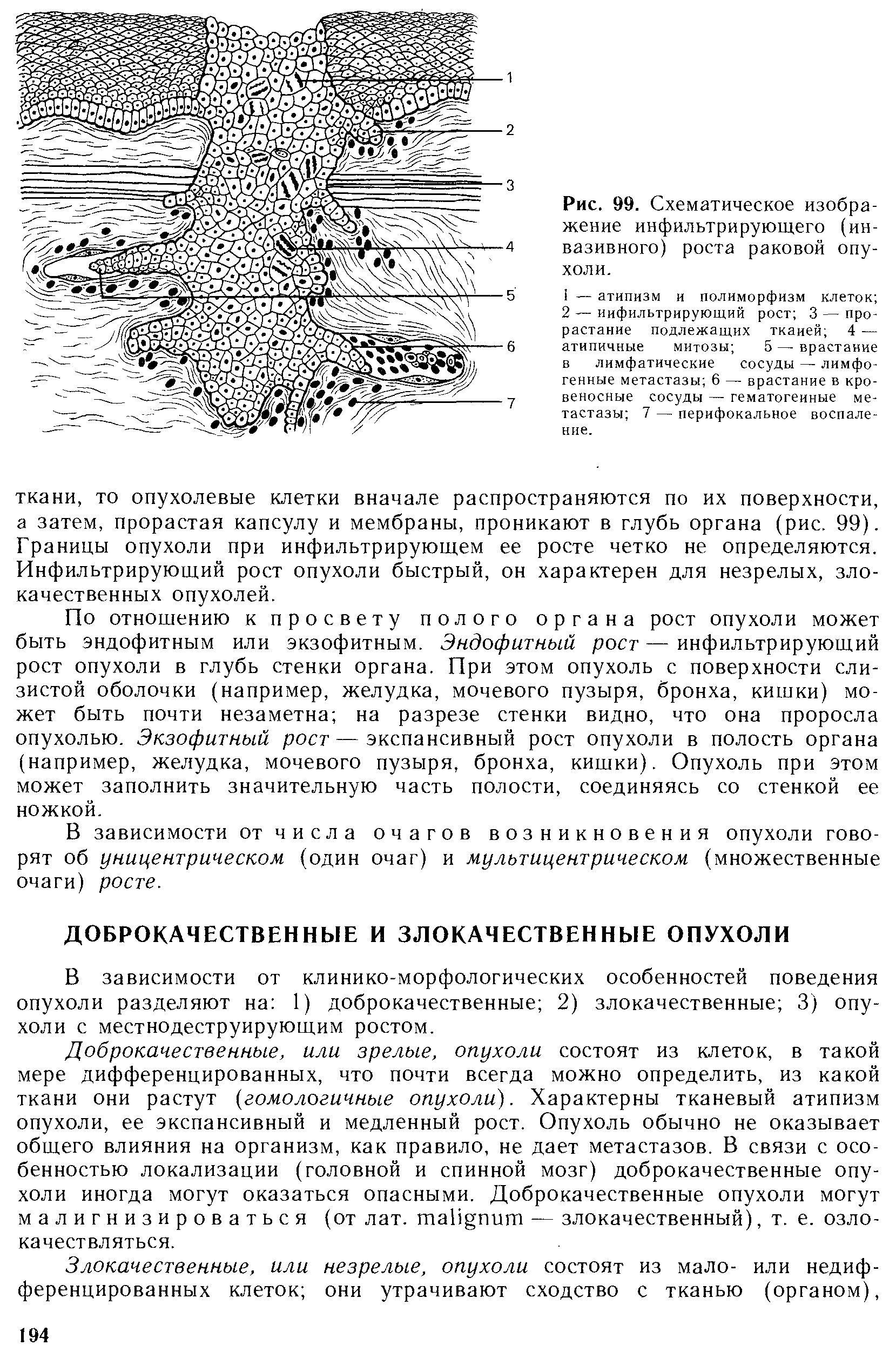 Рис. 99. Схематическое изображение инфильтрирующего (инвазивного) роста раковой опухоли.