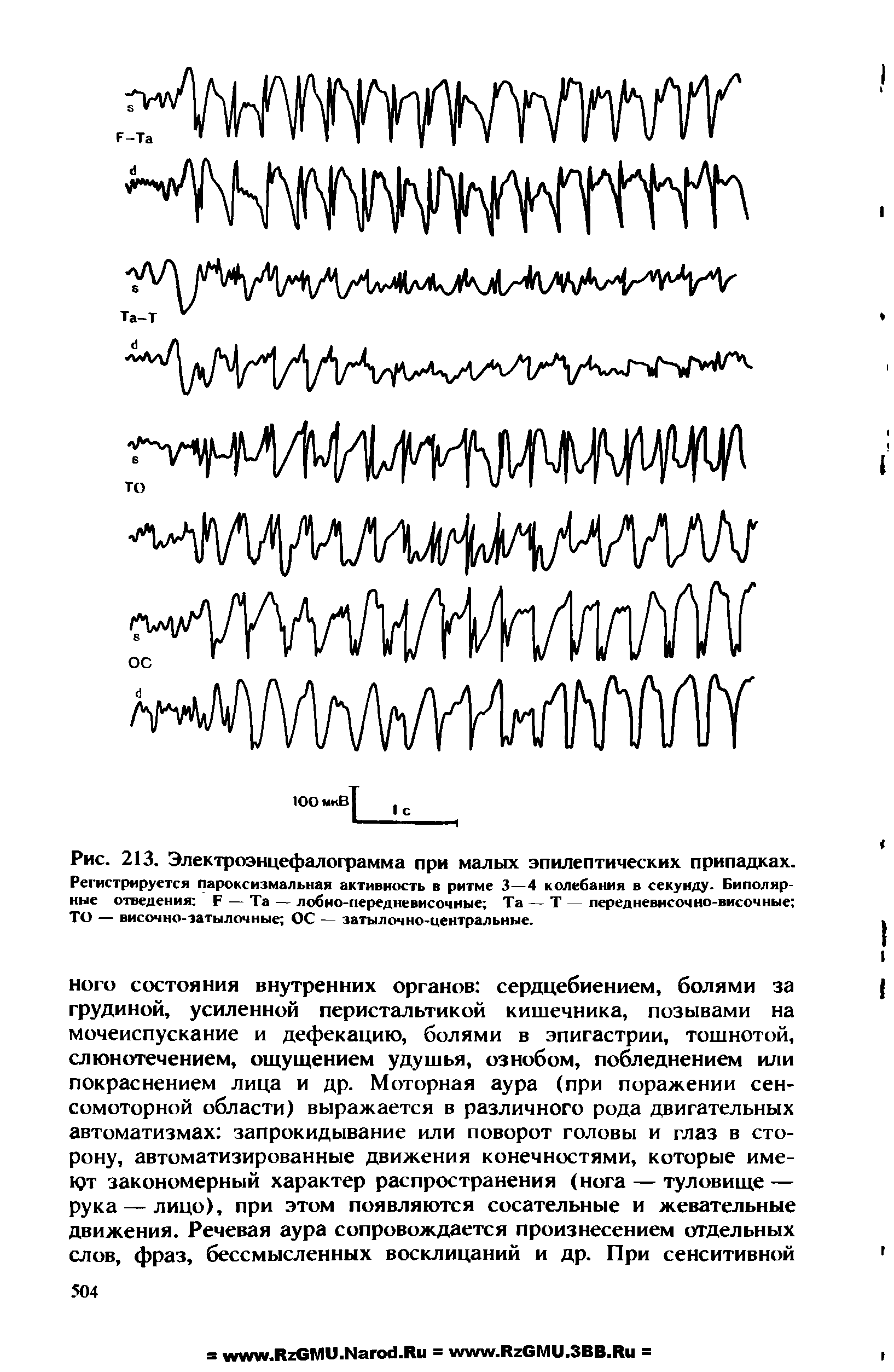 Рис. 213. Электроэнцефалограмма при малых эпилептических припадках. Регистрируется пароксизмальная активность в ритме 3—4 колебания в секунду- Биполярные отведения Б — Та — лобно-передневисочные Та — Т — передневнсочно-височные ТО — височно-затылочные ОС — затылочно-центральные.