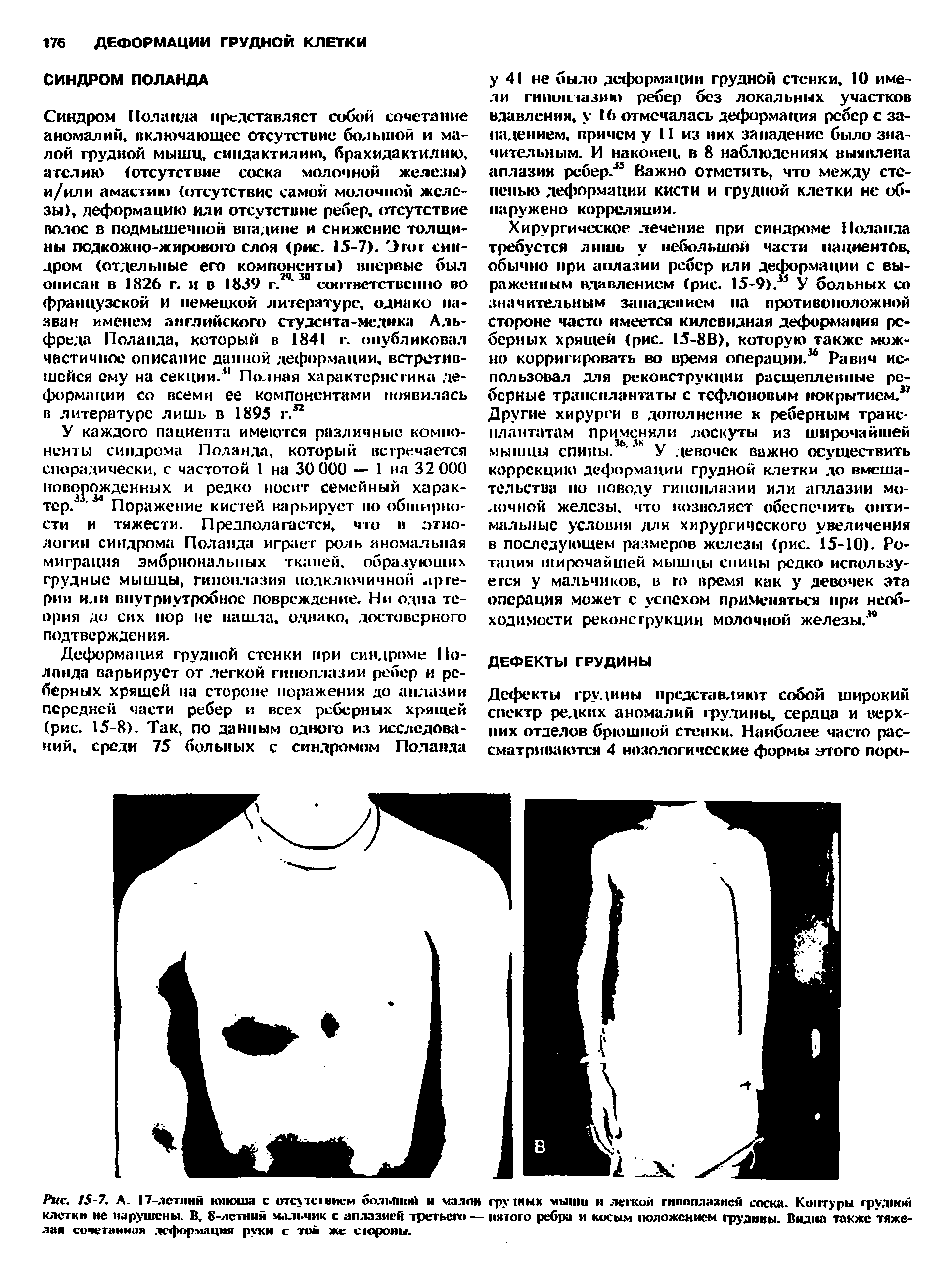 Рис. 15-1. А. 17-летний юноша с отсутсчвисм большой и чалой грудных мыши и легкой гипоплазией соска. Контуры грудной клетки не нарушены. В, 8-летннй мальчик с аплазией третьего — пятого ребра и косым положением грудины. Видна также тяжелая сочетанная деформация руки с тон же сгороны.