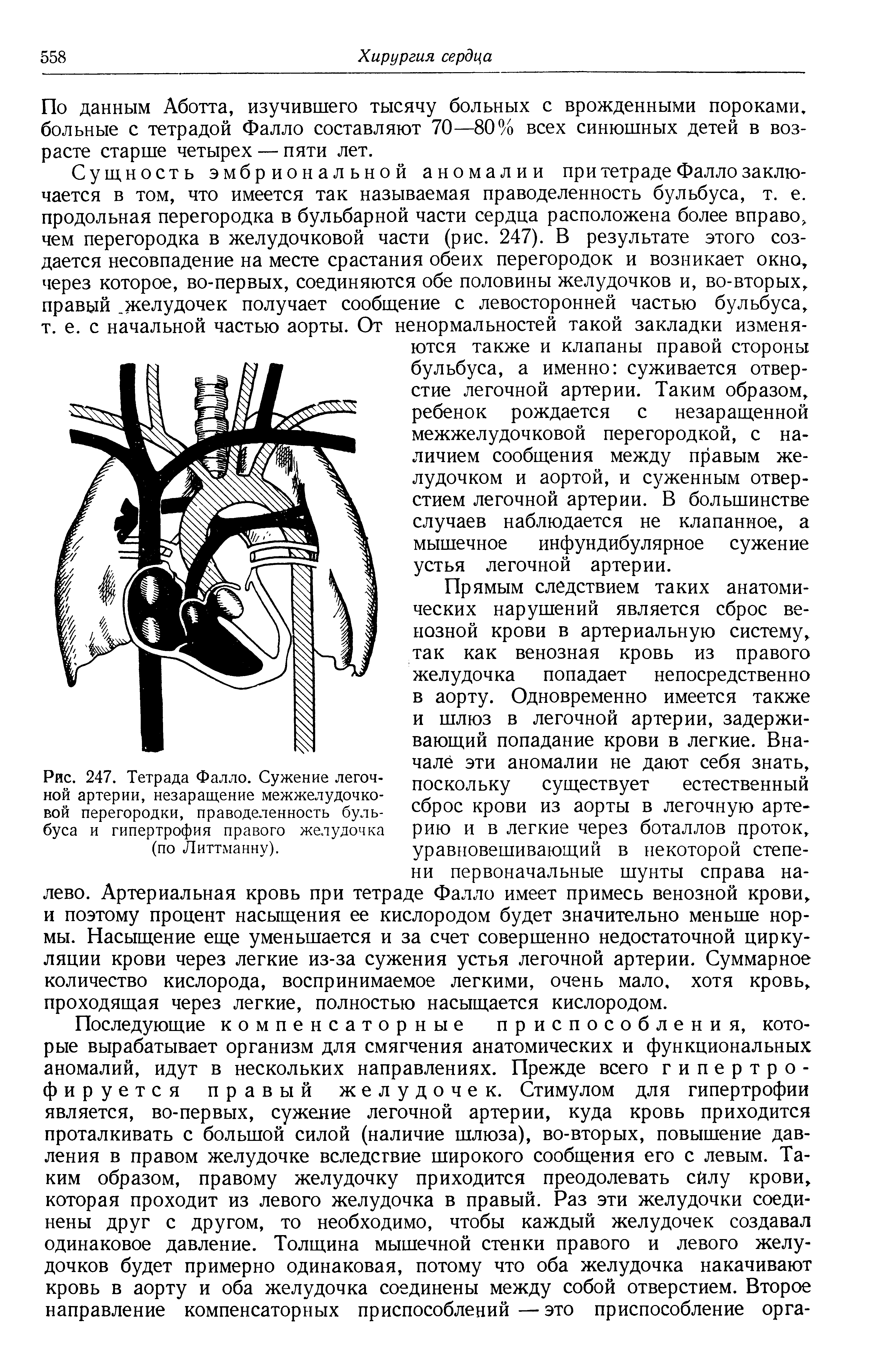 Рис. 247. Тетрада Фалло. Сужение легочной артерии, незаращение межжелудочковой перегородки, праводеленность бульбуса и гипертрофия правого желудочка (по Литтманну).